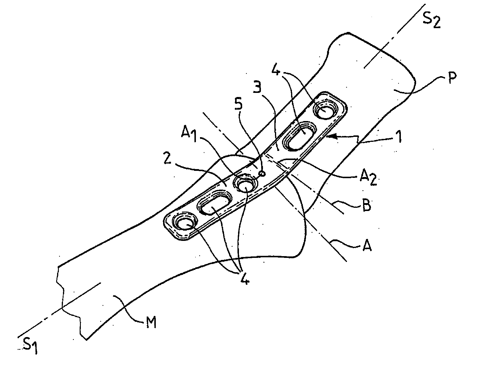 Plate for fixing the bones of a joint, in particular a metatarso-phalangeal joint