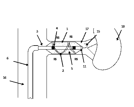 Balloon expanding renal artery sympathetic nerve ablation catheter