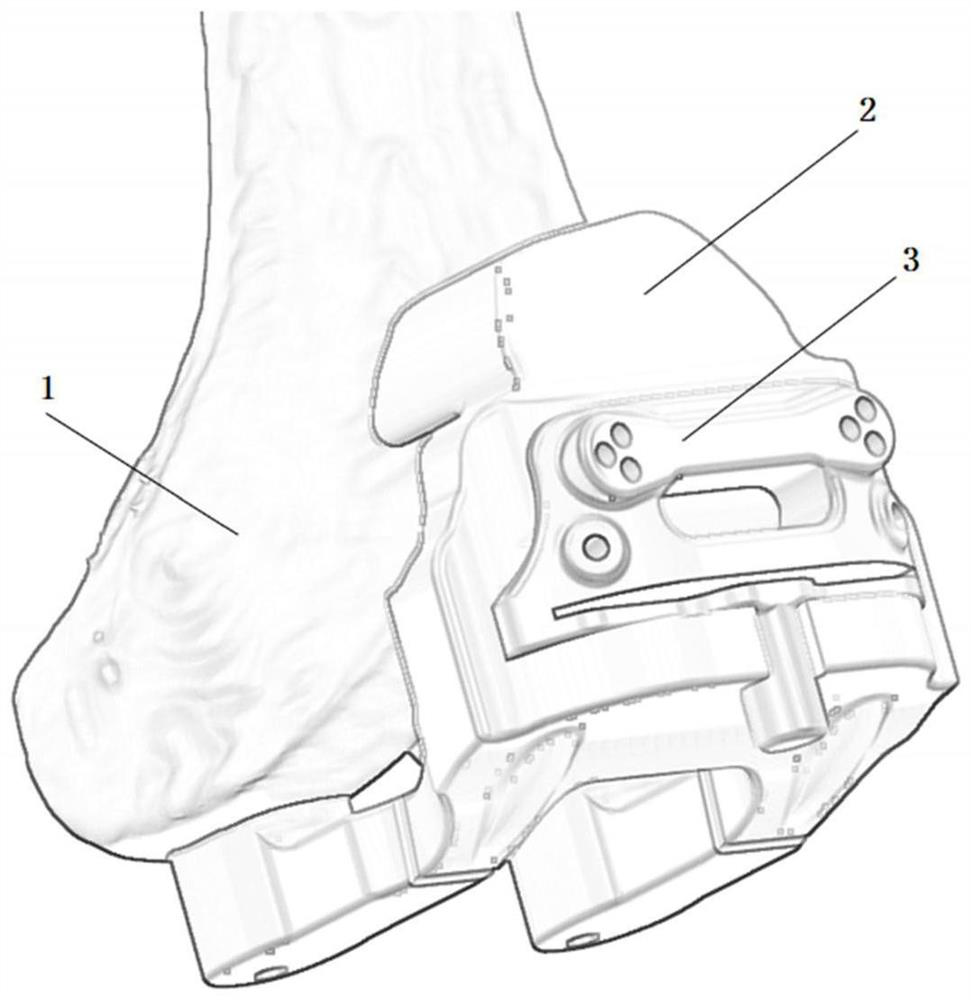 Thighbone osteotomy device and thighbone osteotomy guide plate assembly