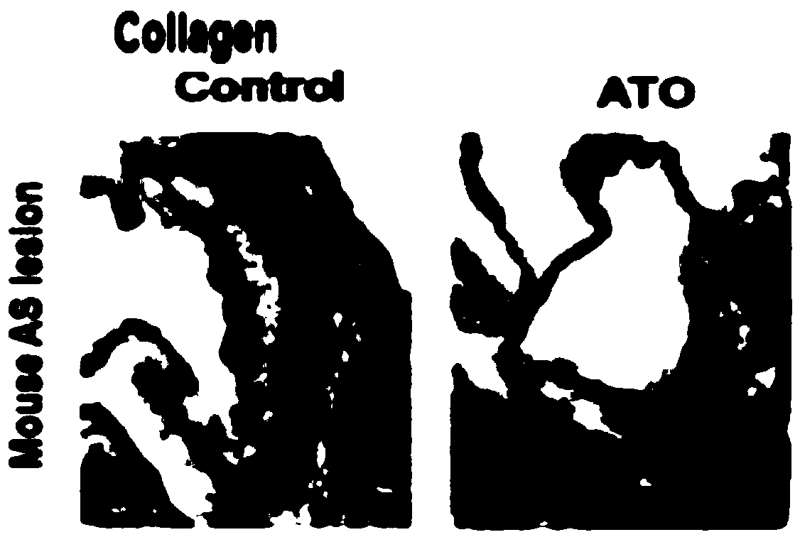 Use of arsenic trioxide in preparation of medicines for treating advanced atherosclerosis