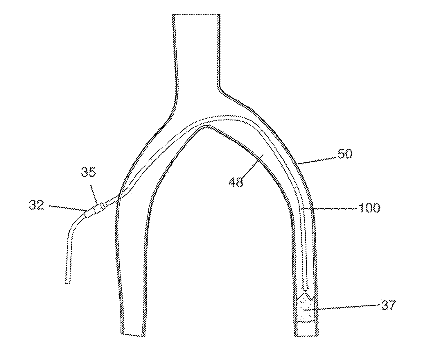 Device and Method for Treating a Chronic Total Occlusion