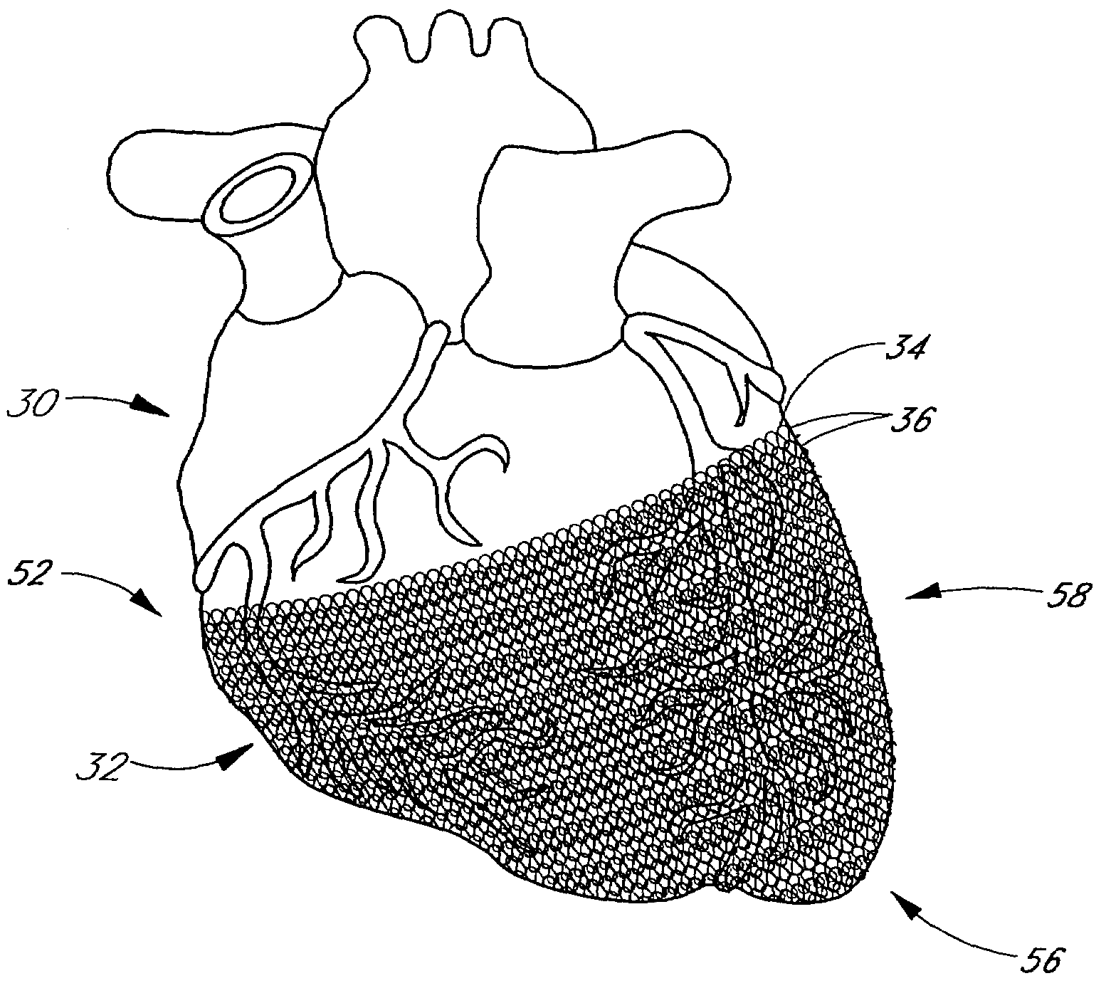 Heart failure treatment device and method