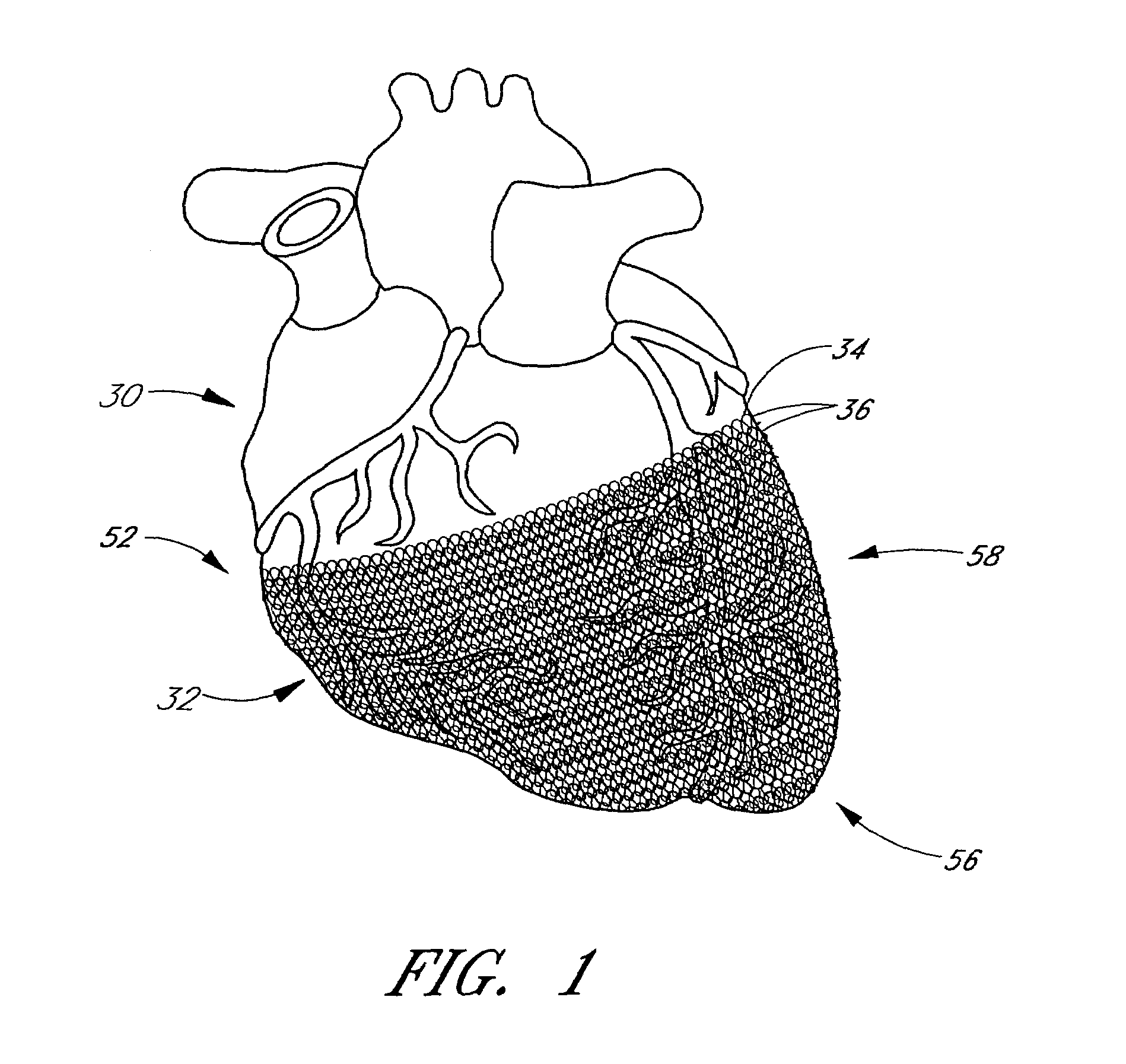 Heart failure treatment device and method