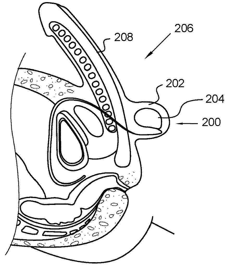 Male Condom Assembly with Integral Trapezoidal-shaped Shield for Inhibiting Skin Contact along The Genitals and Testicles