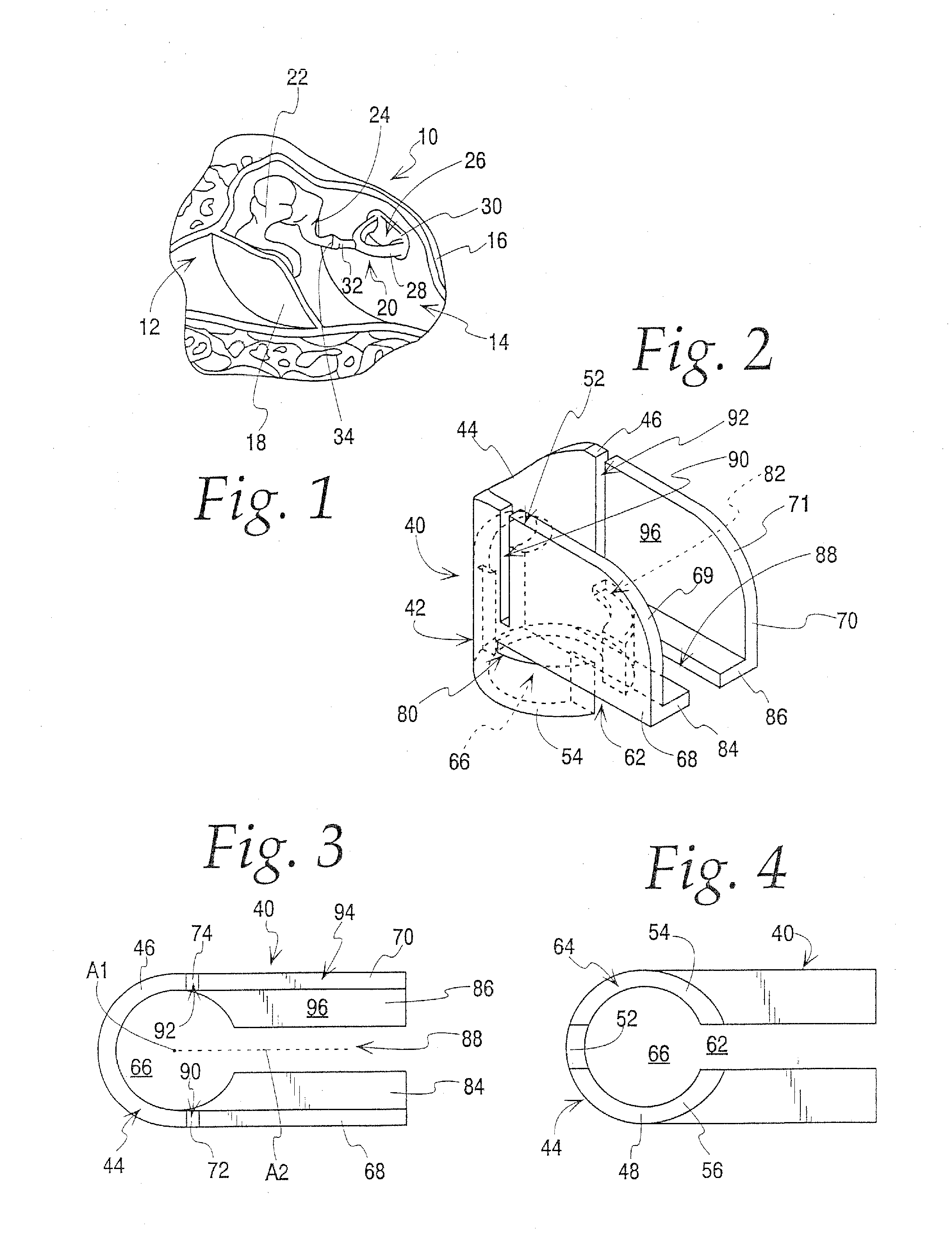 Middle Ear Prosthesis