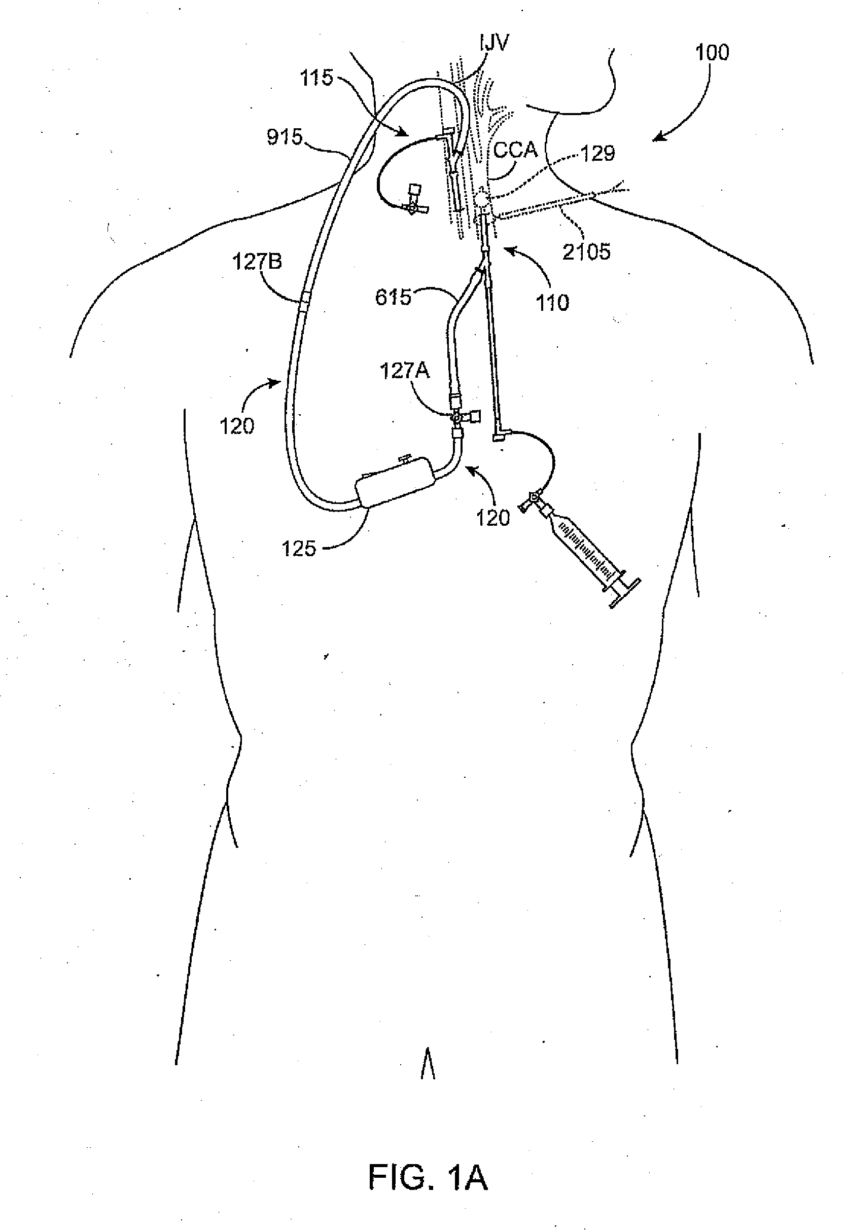 Methods and systems for establishing retrograde carotid arterial blood flow