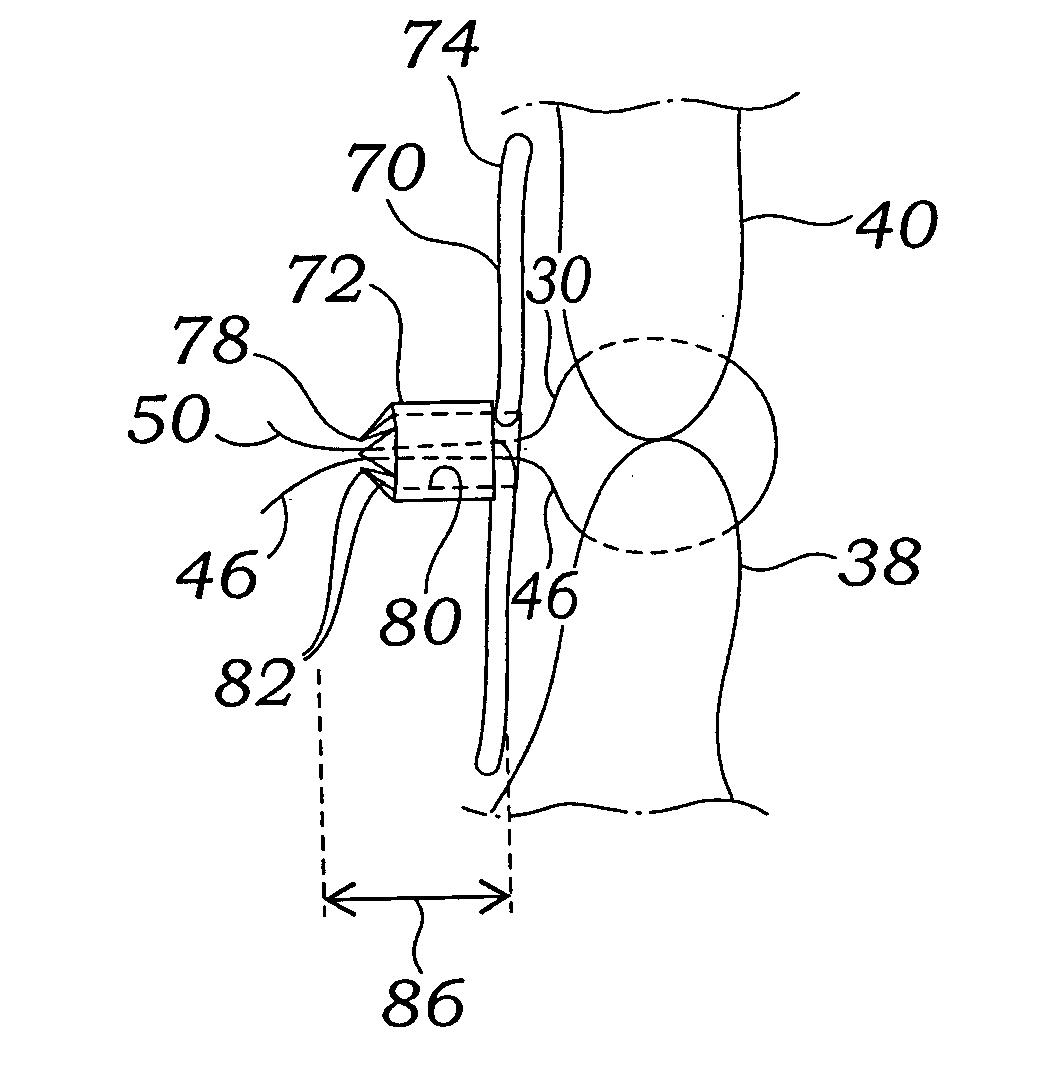 Expandable clip for tissue repair