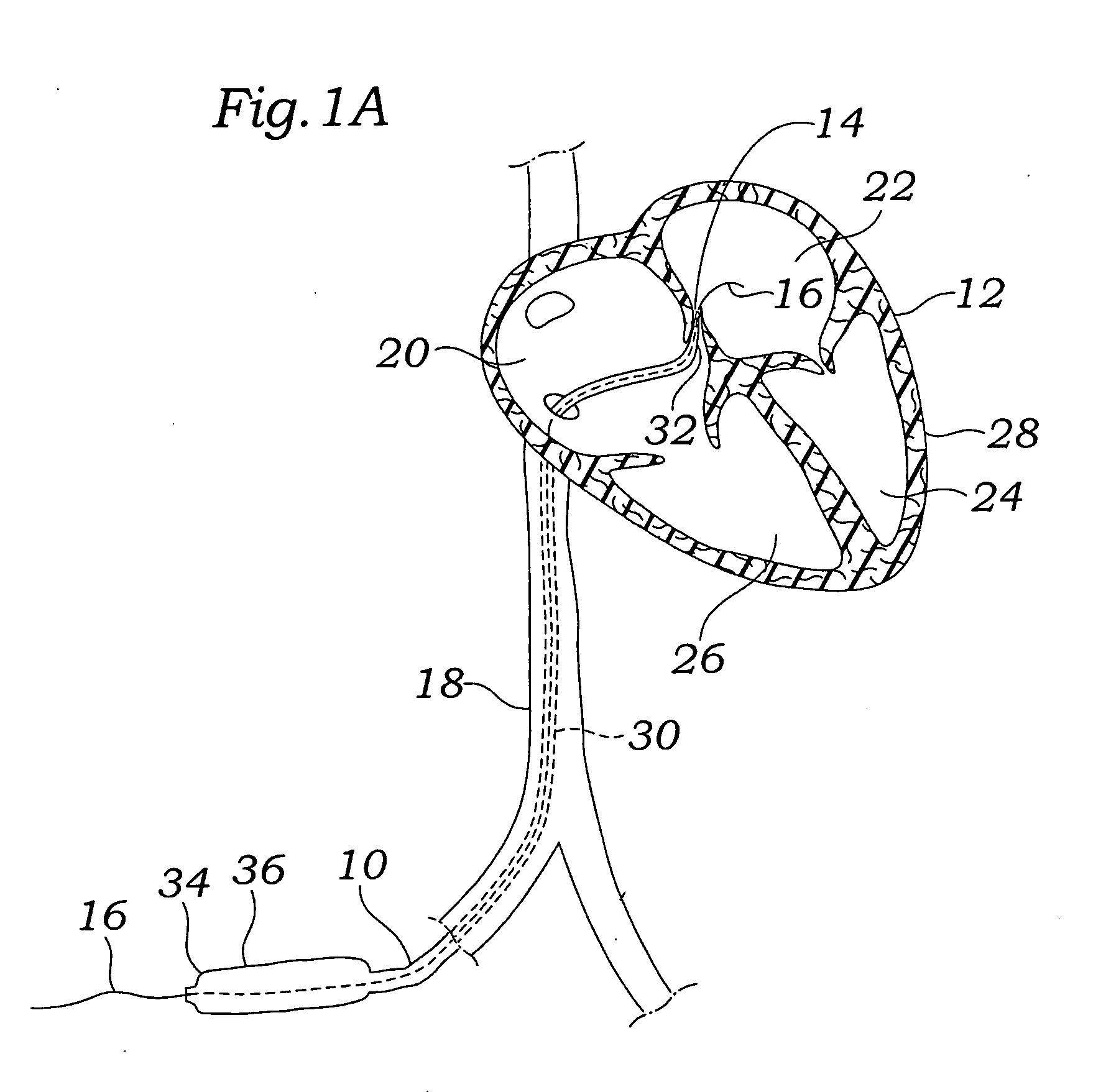 Expandable clip for tissue repair