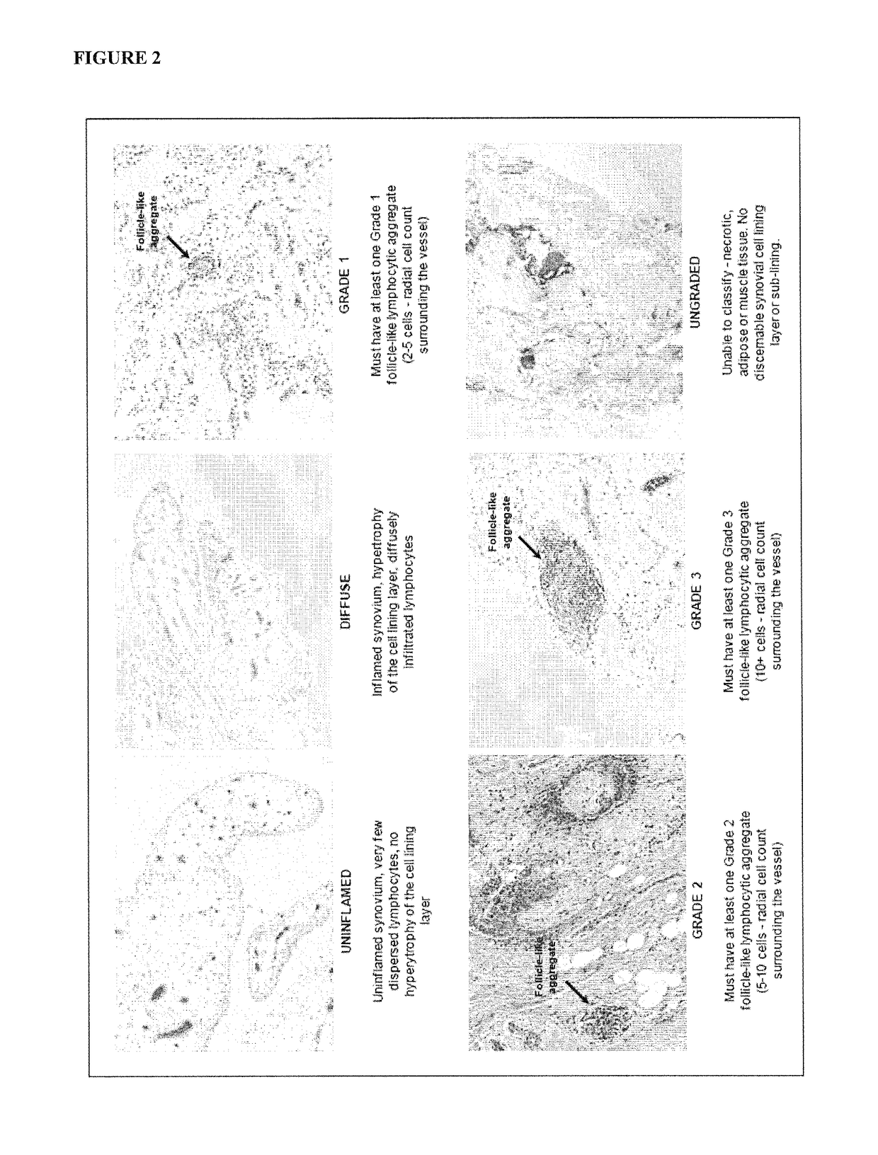 Method for Treating Rheumatoid Arthritis