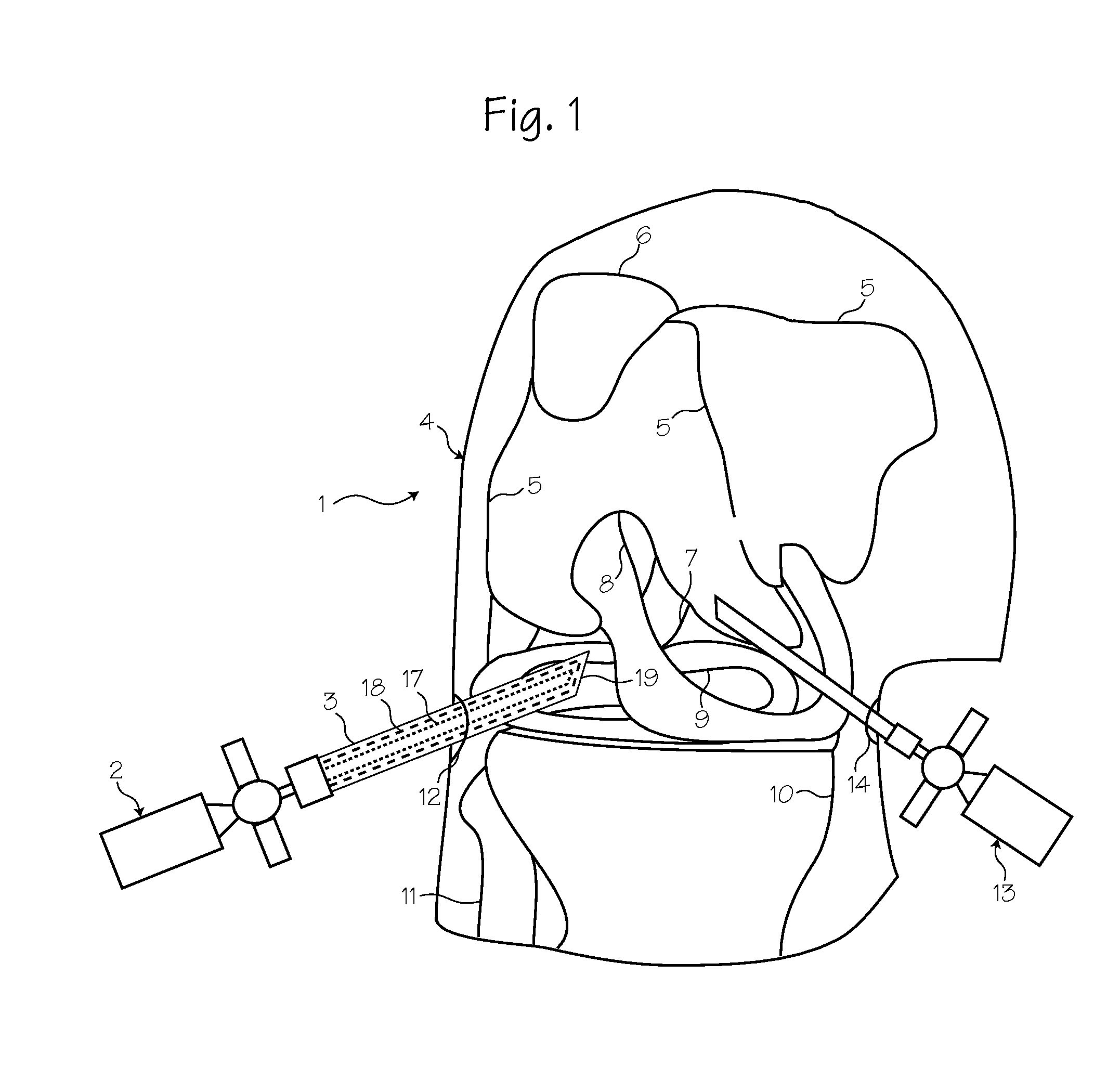 Rigid Arthroscope System