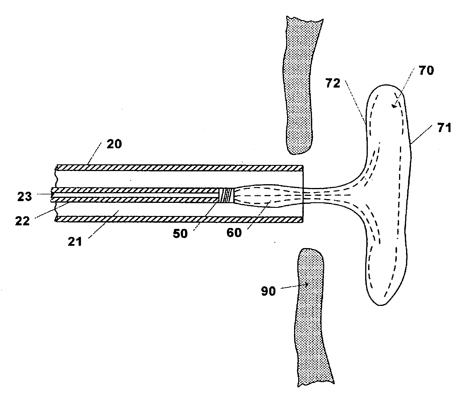 Device and Method for Closure of Atrial Septal Defects