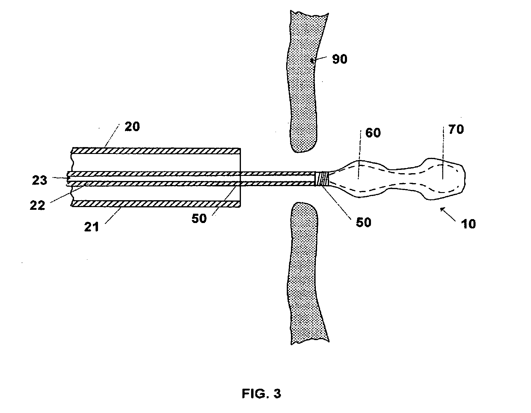 Device and Method for Closure of Atrial Septal Defects