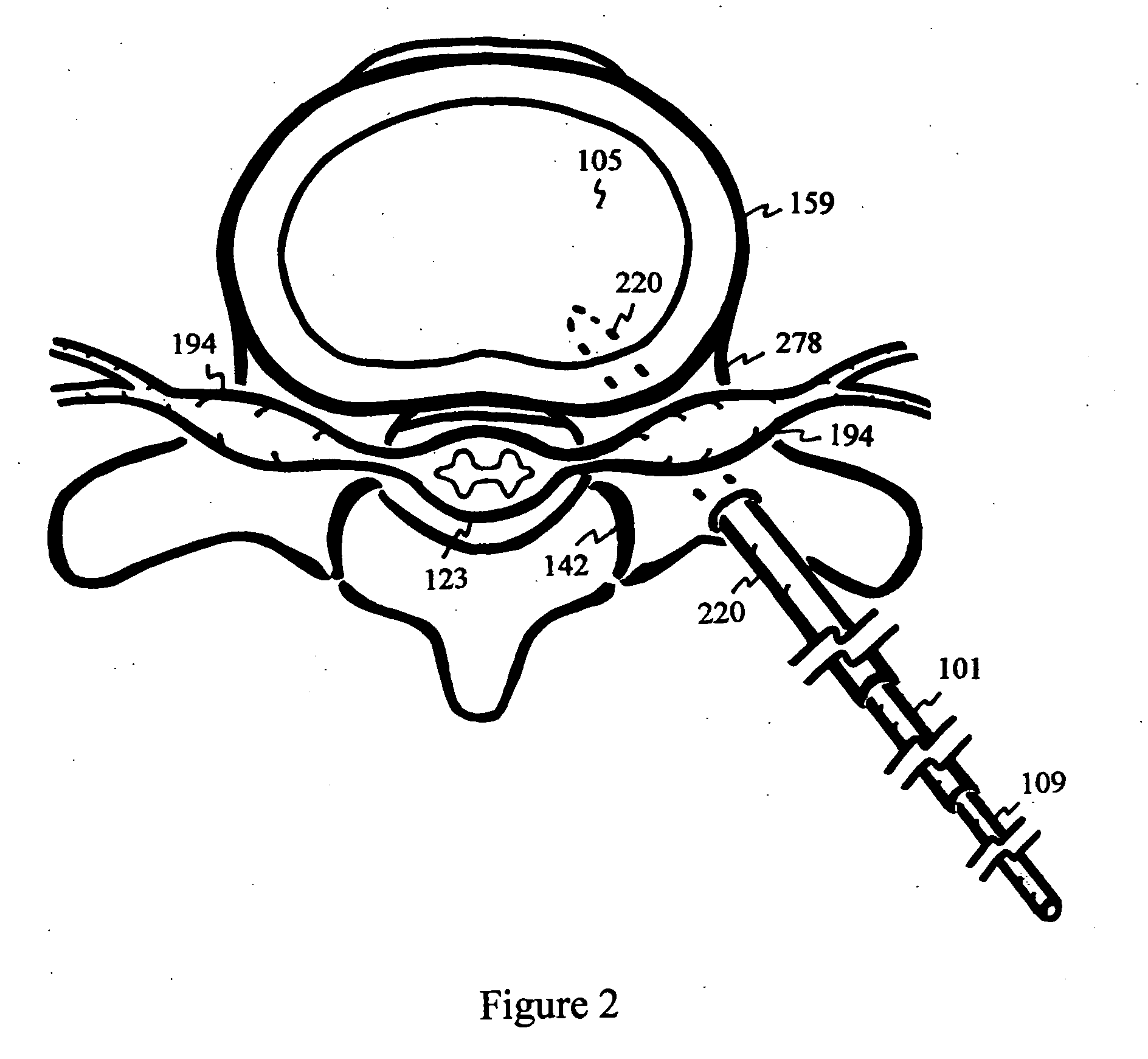 Disc shunt delivery devices