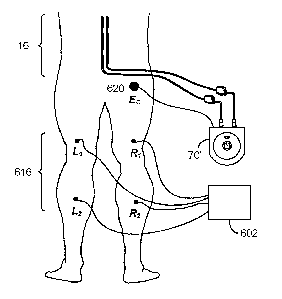 System to Estimate the Location of a Spinal Cord Physiological Midline