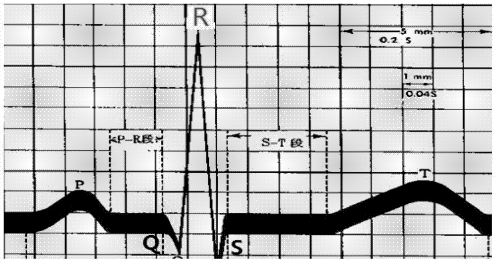 Method and system for analyzing electrocardiogram data