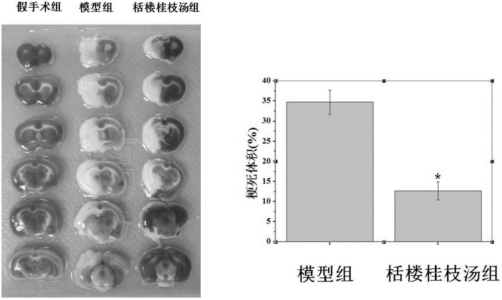 Application of Tianlou Guizhi decoction in treatment of post-stroke spasm