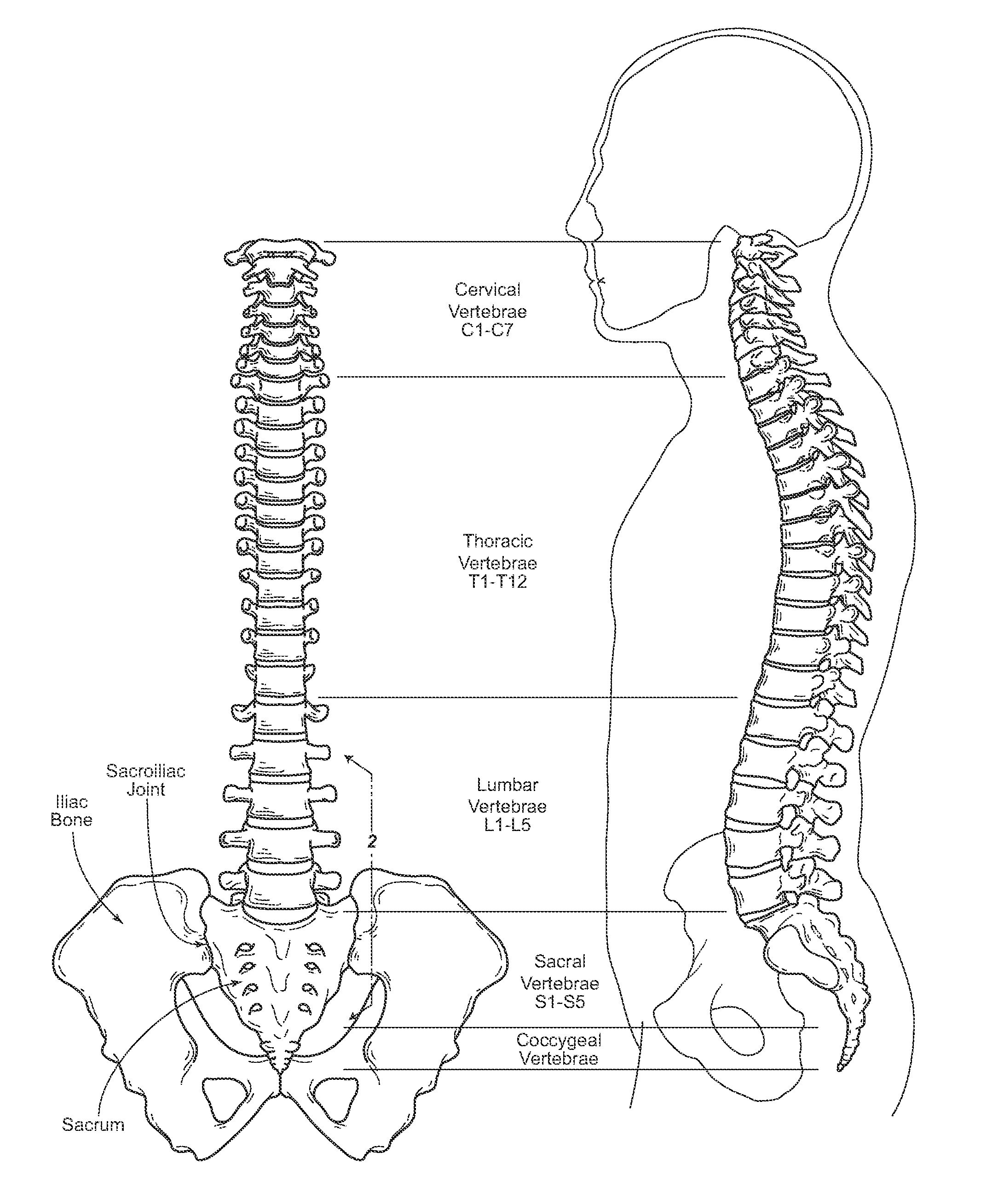 Devices, systems, and methods for inter-transverse process dynamic stabilization