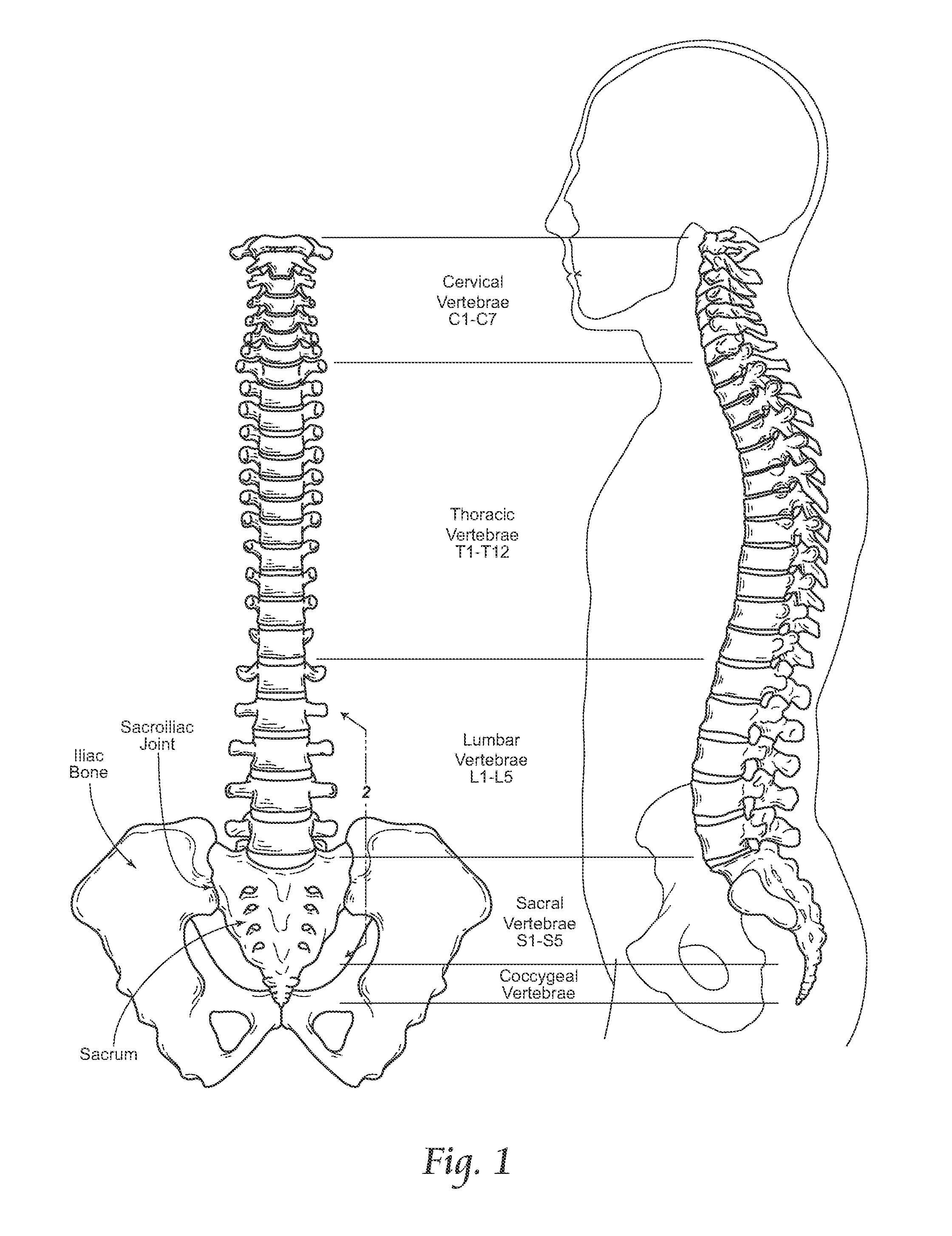 Devices, systems, and methods for inter-transverse process dynamic stabilization