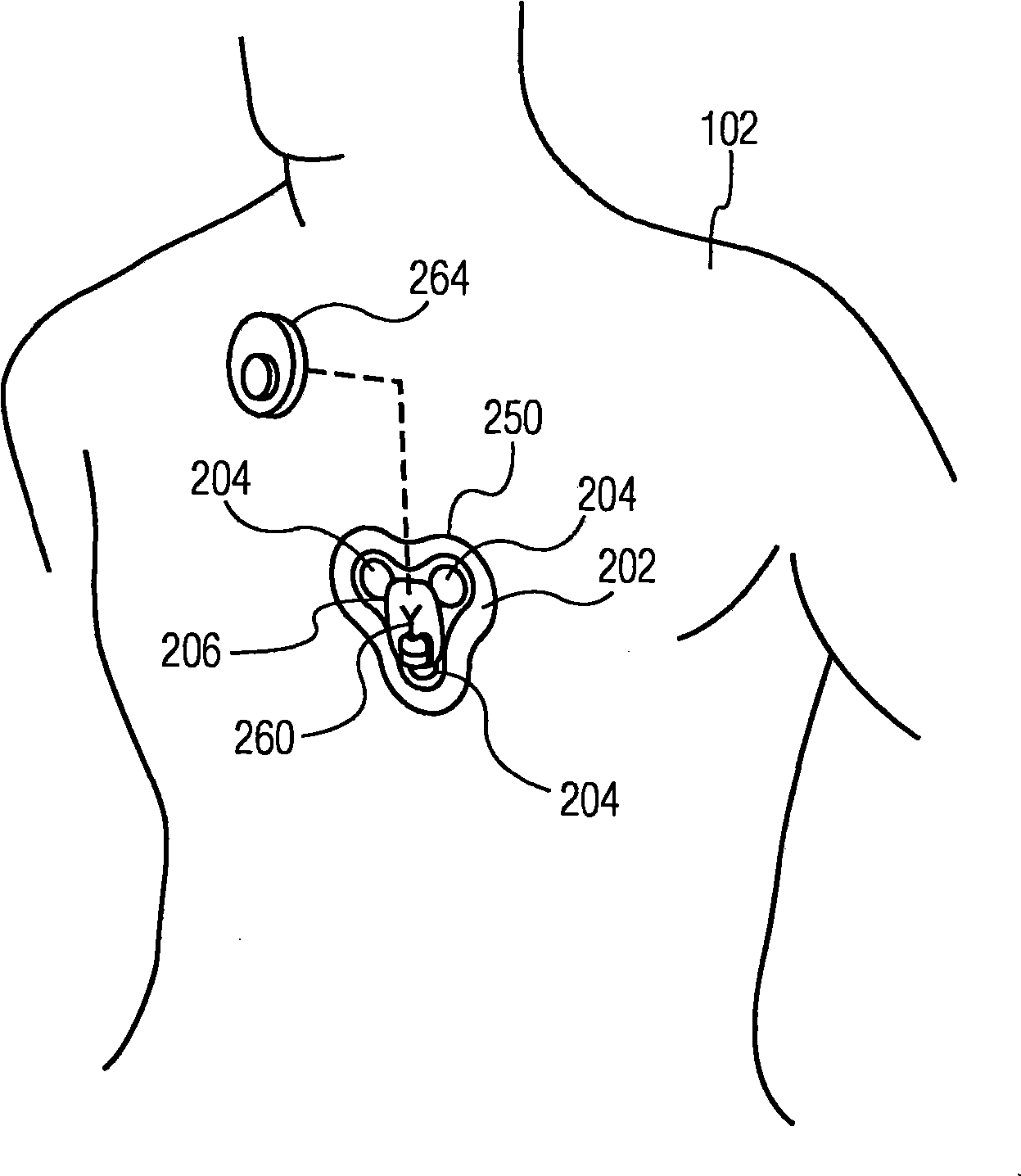 Handheld, repositionable ECG detector