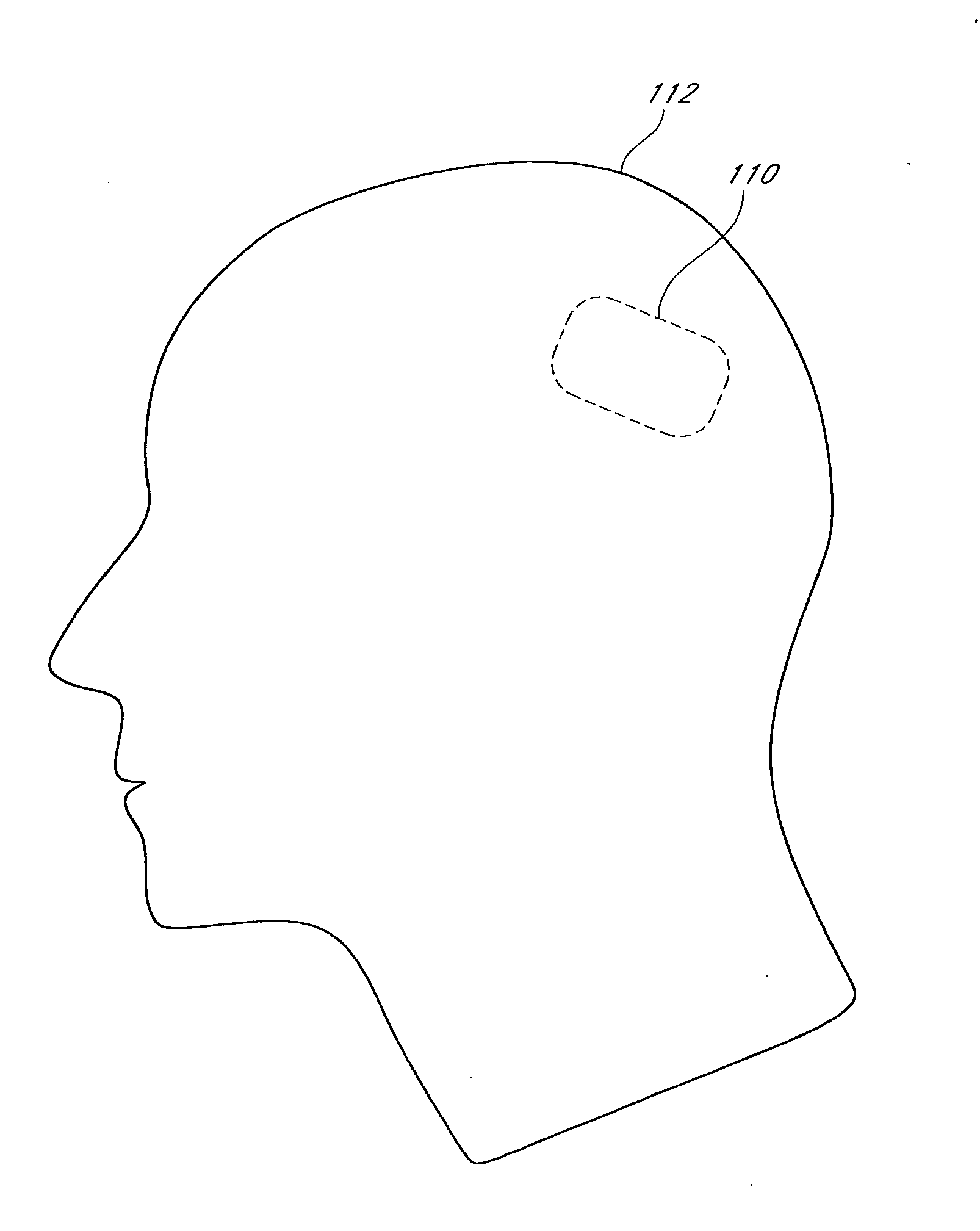 Implantable seizure monitor