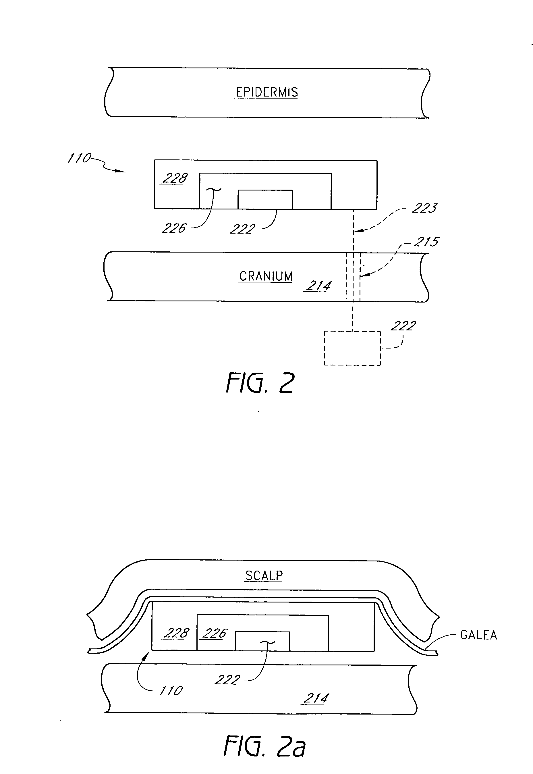 Implantable seizure monitor