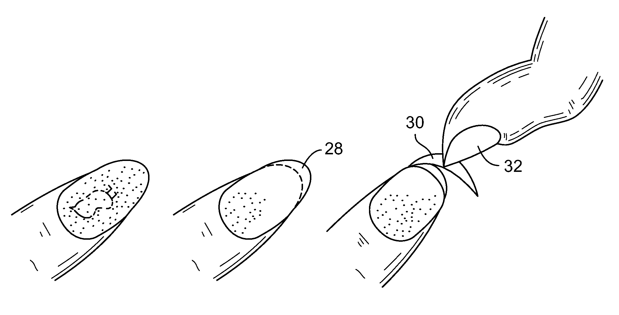 Method and product for attaining a french manicure using a dry nail applique