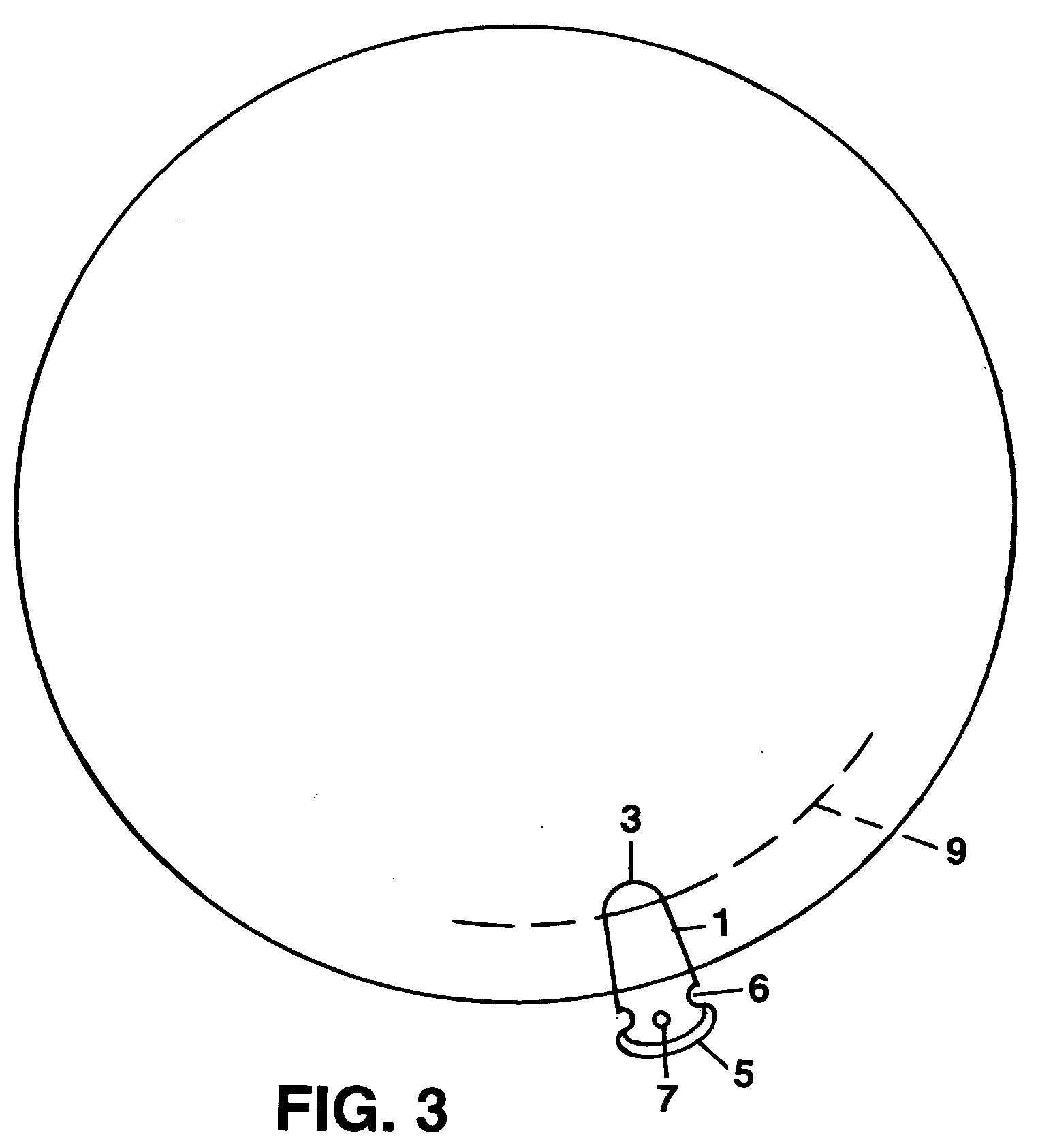 Trans-corneal shunt and method