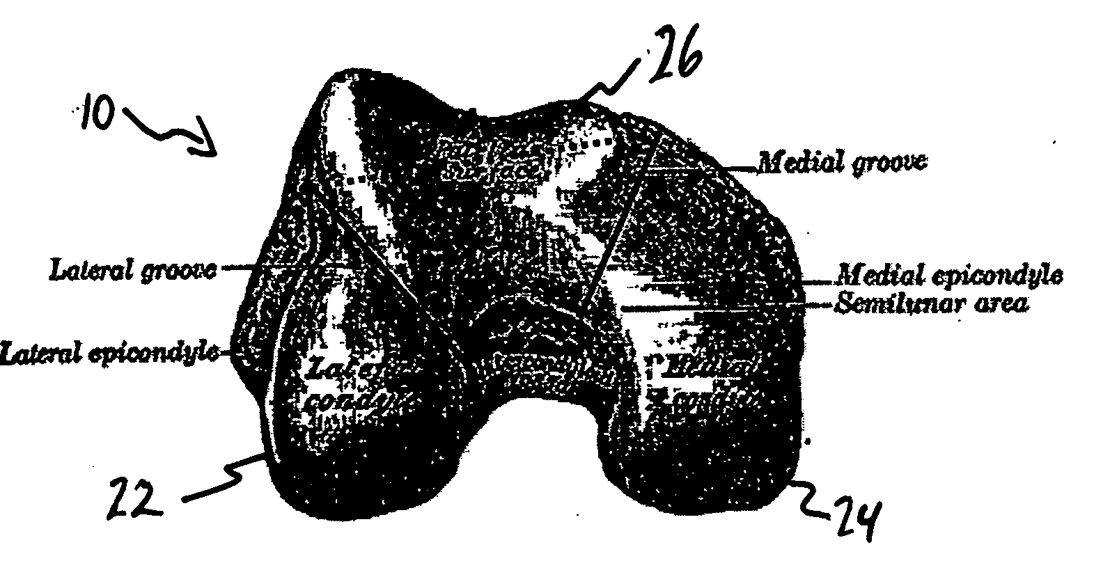 Osteochondral repair using plug fashioned from partial distal allograft femur or condyle