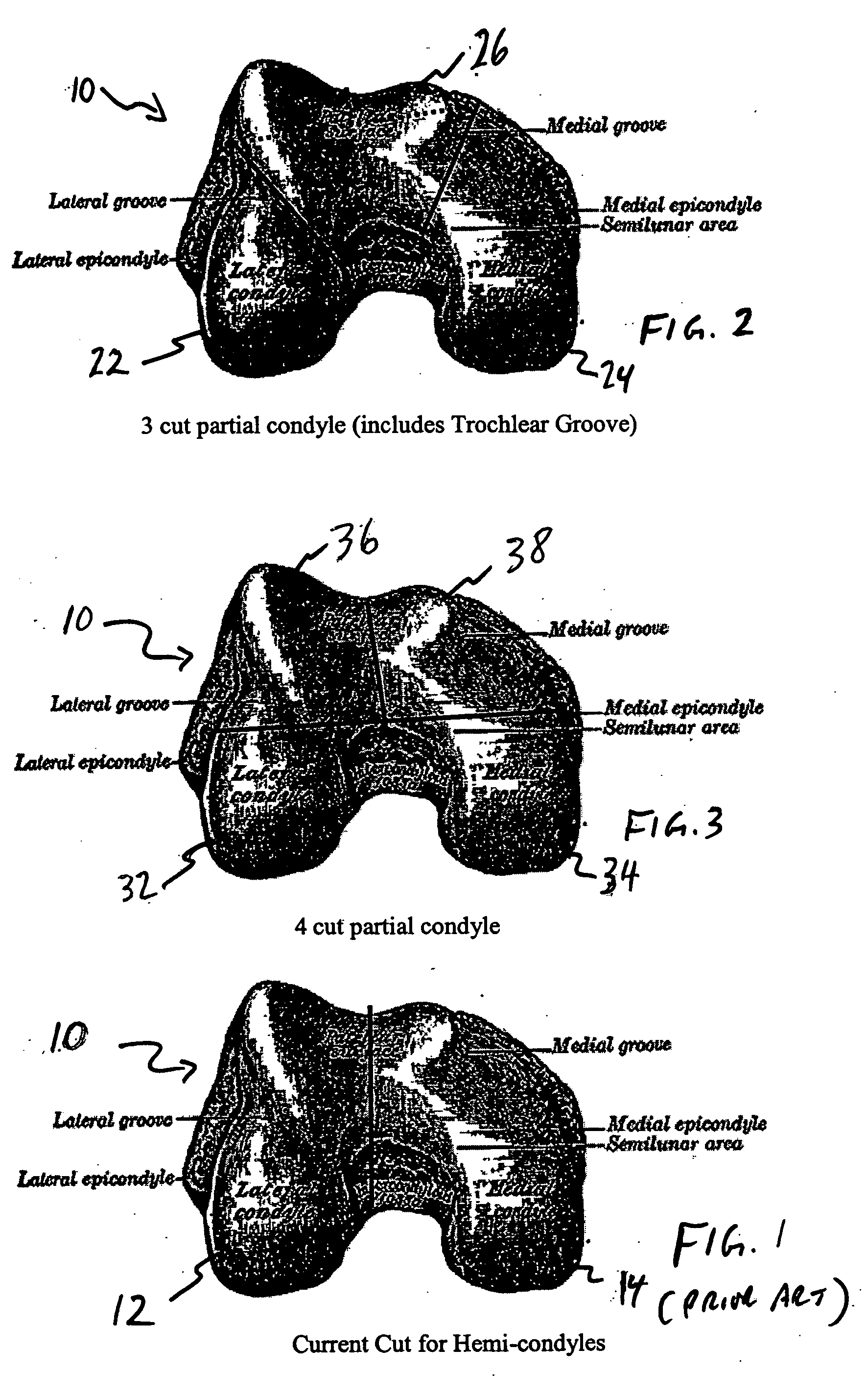 Osteochondral repair using plug fashioned from partial distal allograft femur or condyle