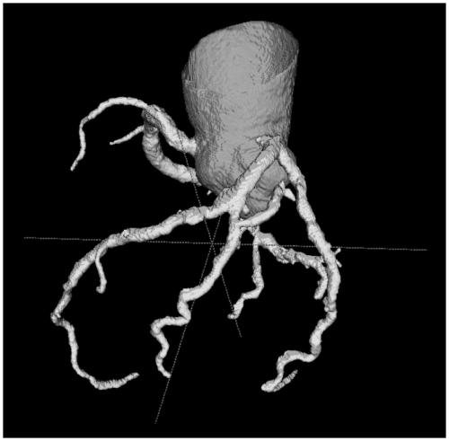 Implant intervention simulation method, selection method, medium and equipment