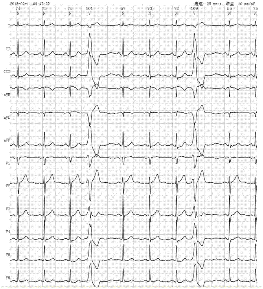 Electrocardiogram signal detection method and system