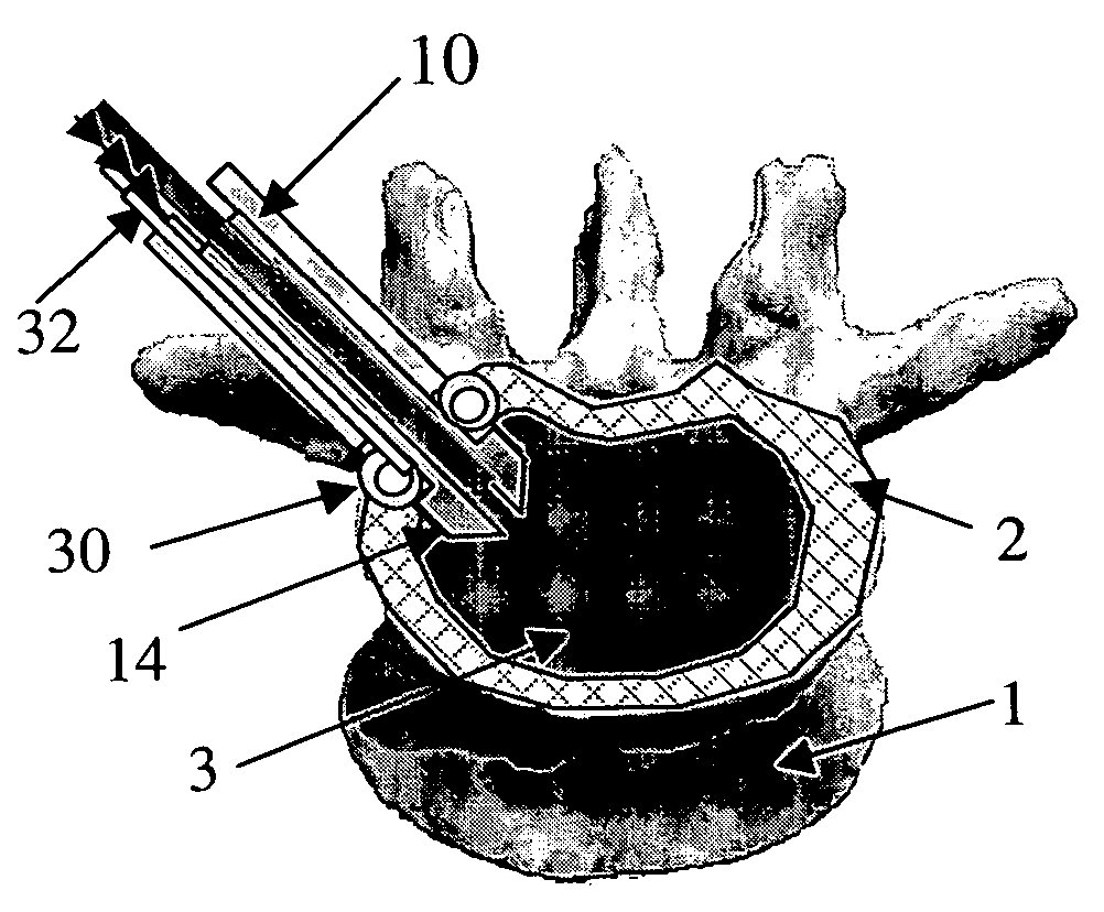 Nucleus augmentation delivery device and technique