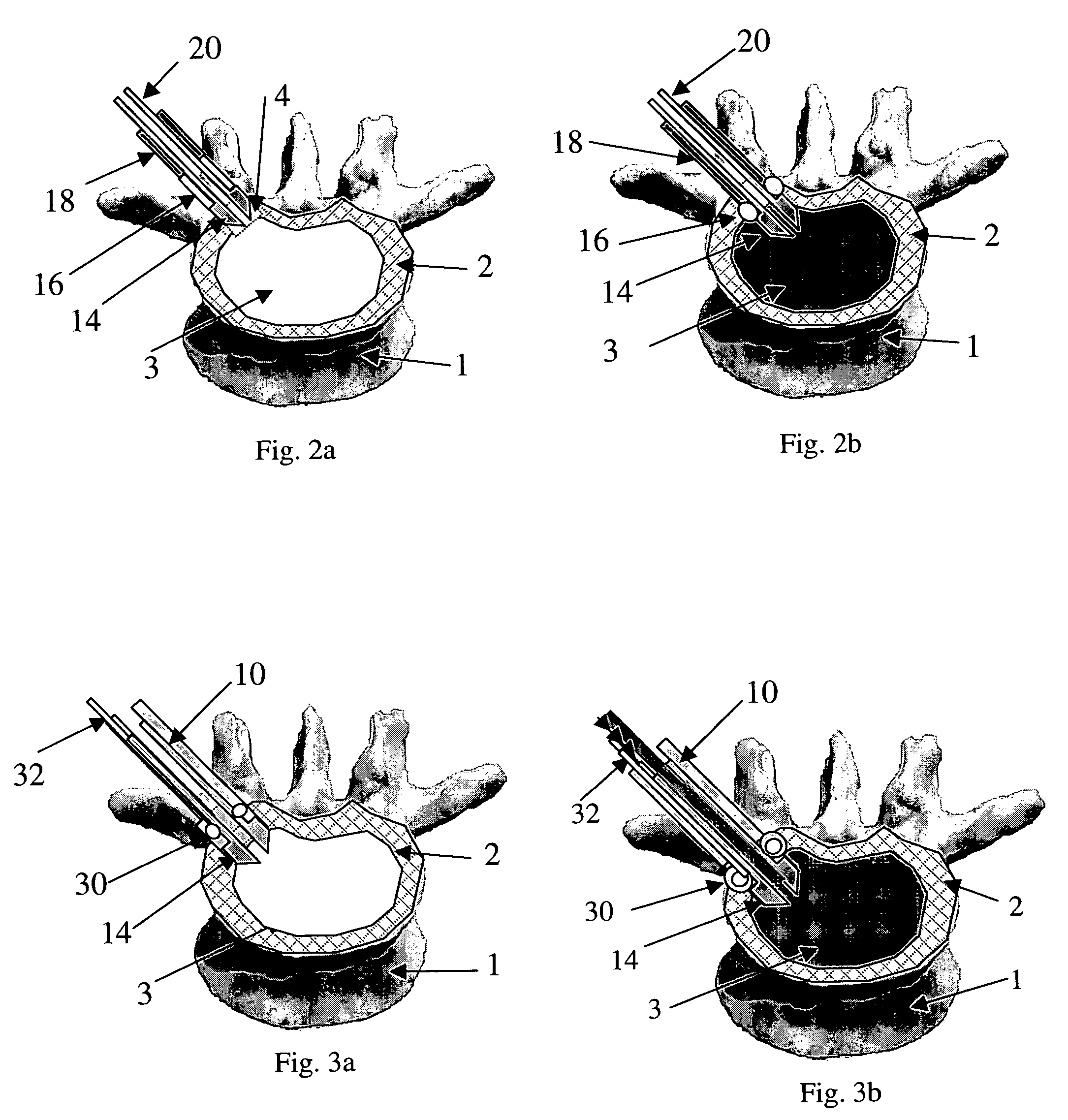 Nucleus augmentation delivery device and technique