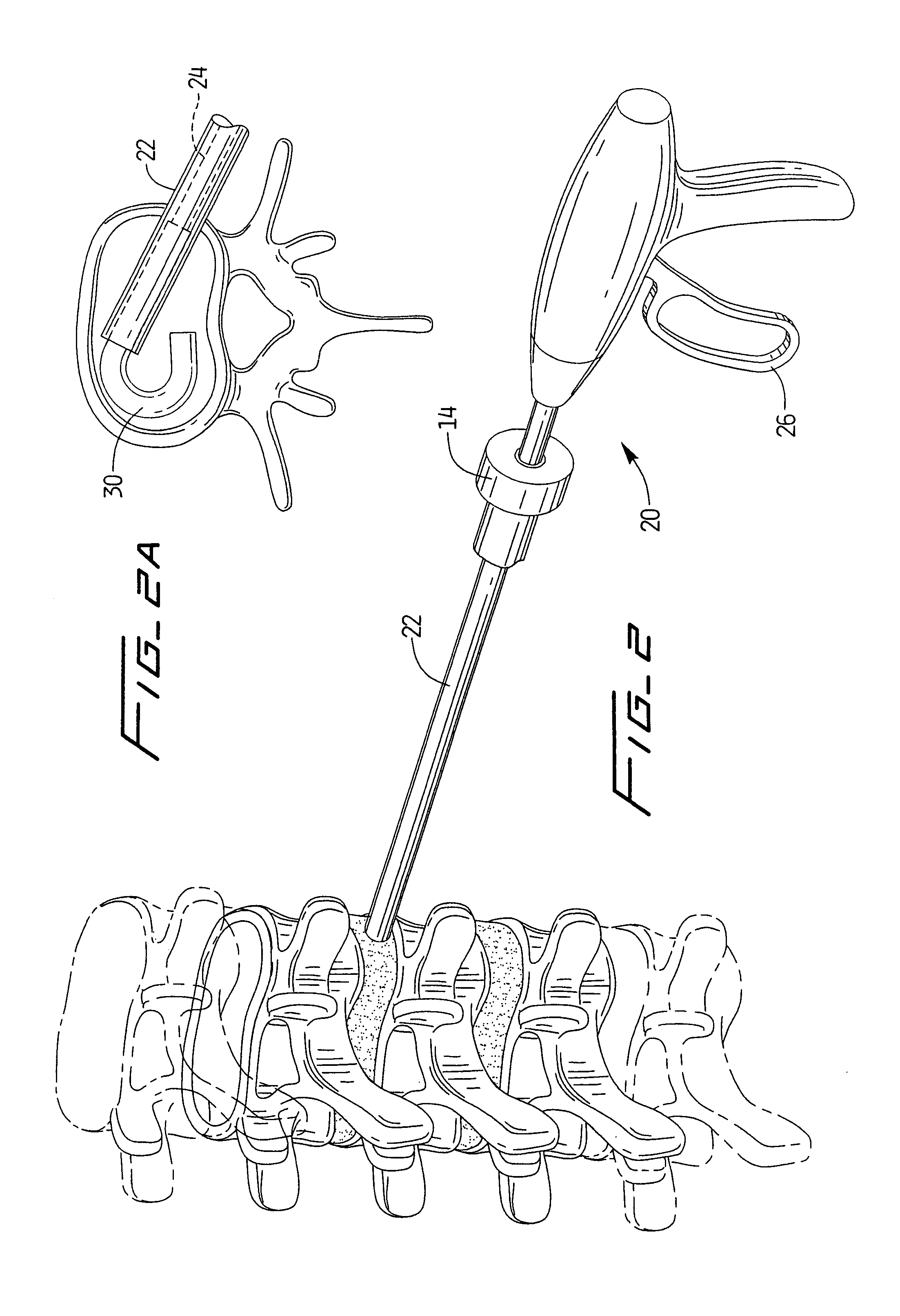 Spinal implant and method of use