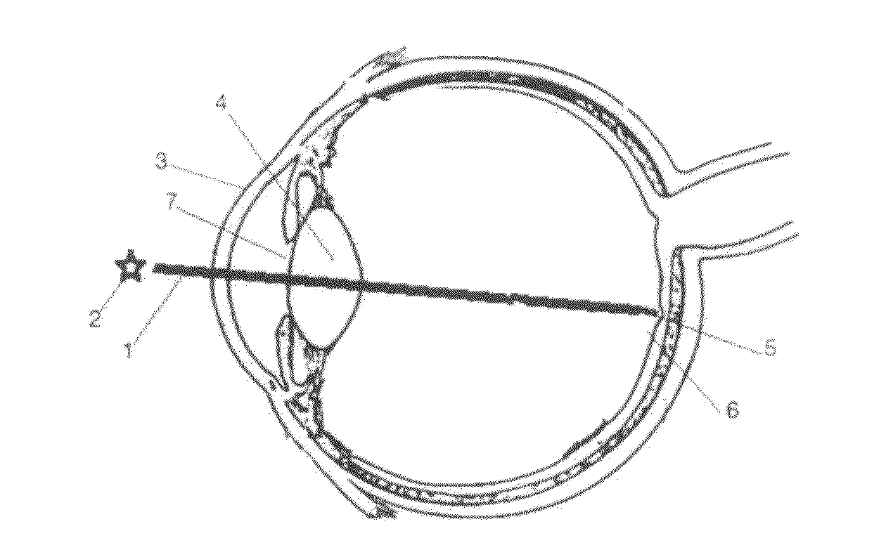 Apparatus and Corneal Remodeling Methods to Improve Vision in Macular Disease