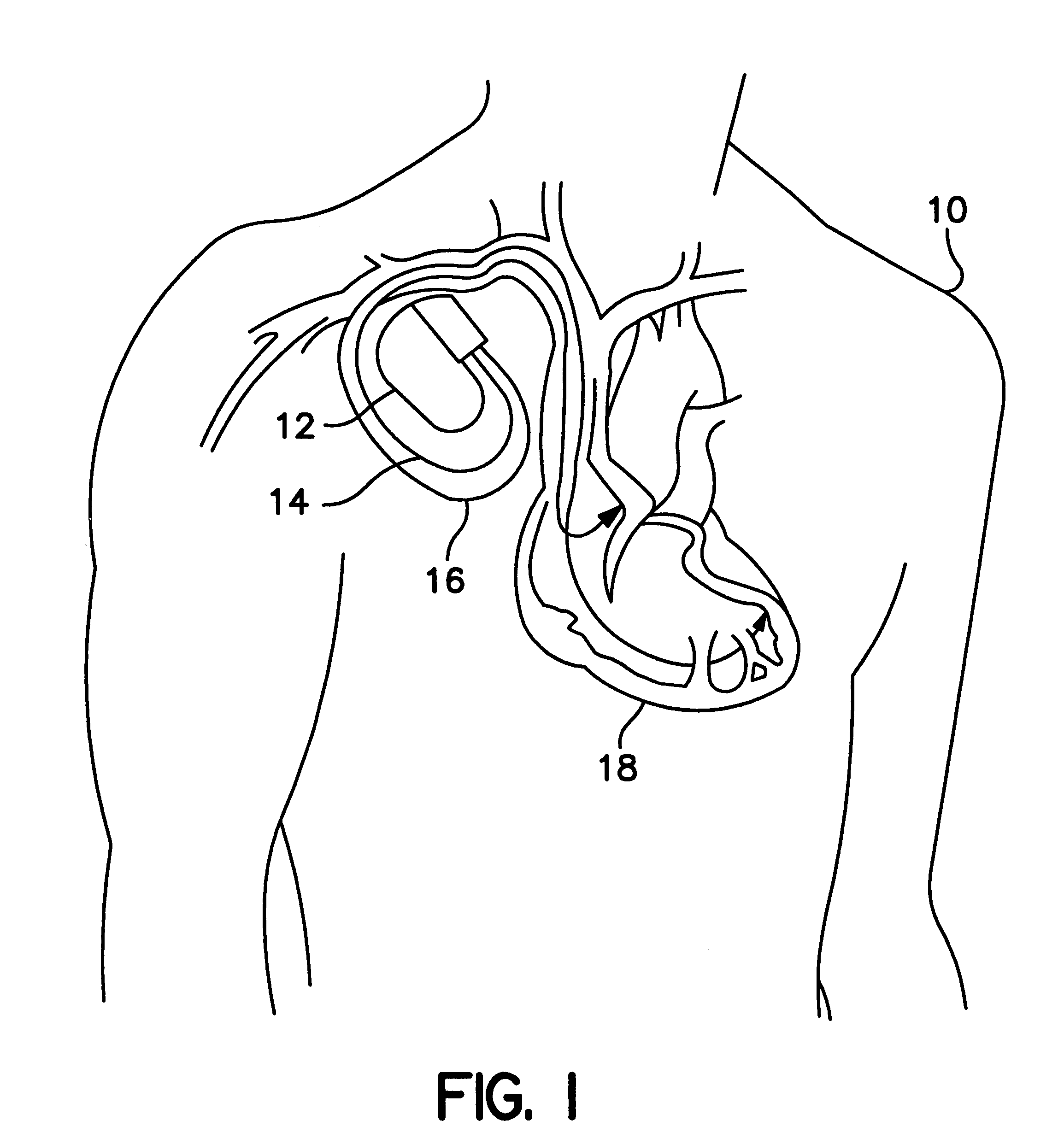 Medical lead conductor fracture visualization method and apparatus