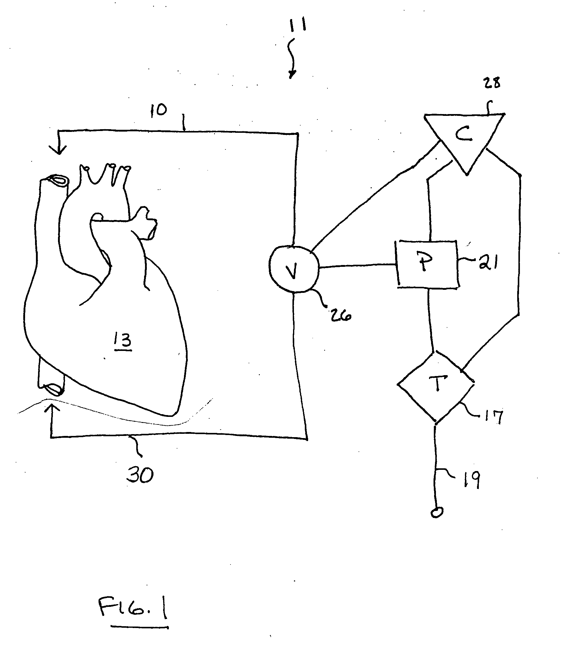 Method and apparatus for treating acute myocardial infarction with hypothermic perfusion