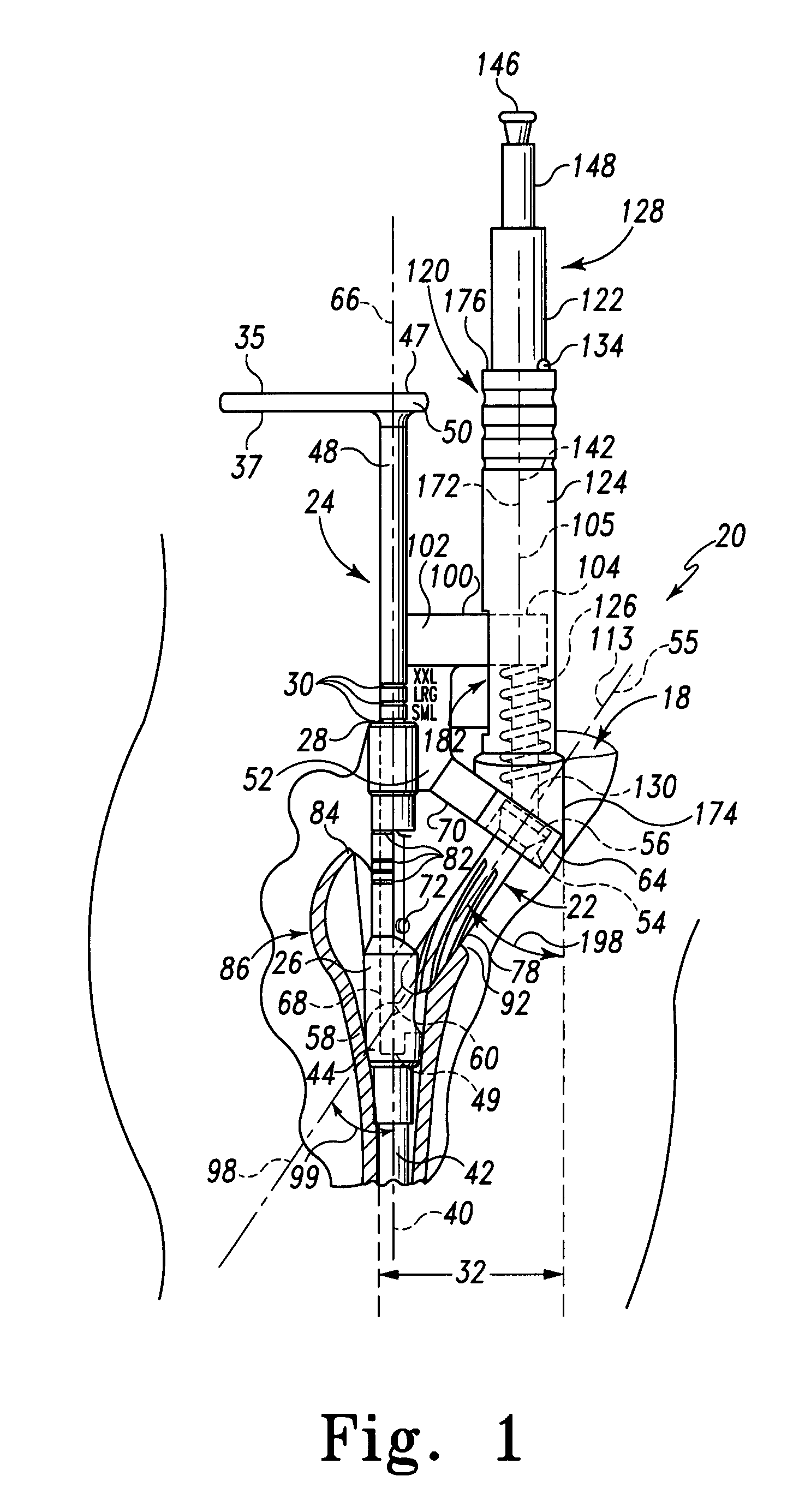 Minimally invasive bone miller apparatus