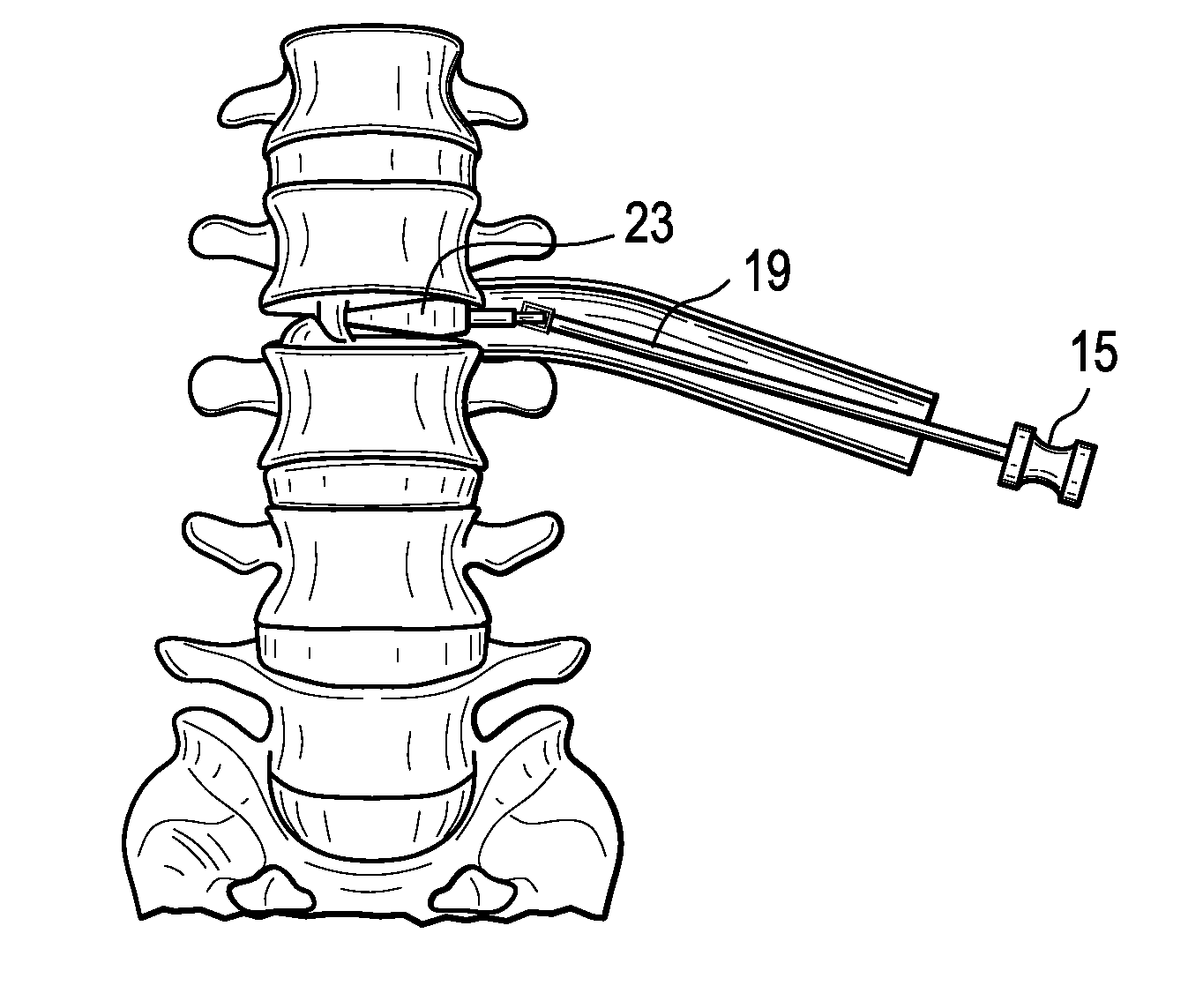 Instruments and Methods for Non-Parallel Disc Space Preparation