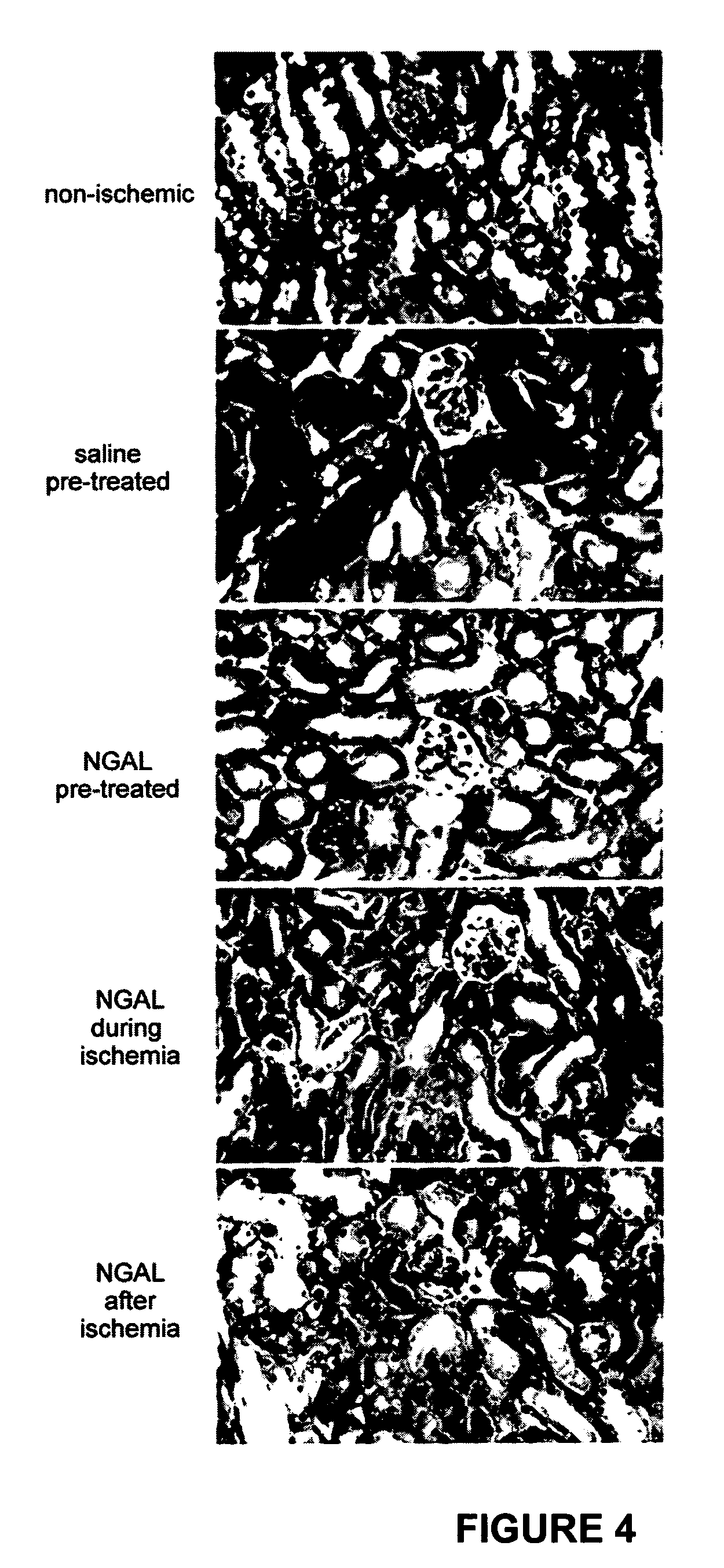 NGAL for reduction and amelioration of ischemic and nephrotoxic injuries