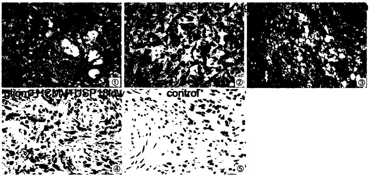 Building method of human spongioblastoma cell SCID mouse brain transplantation tumor model