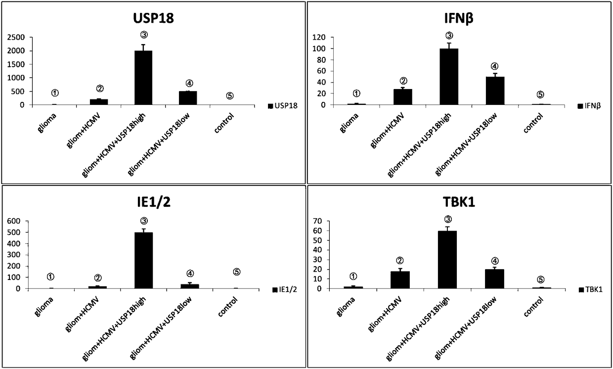 Building method of human spongioblastoma cell SCID mouse brain transplantation tumor model