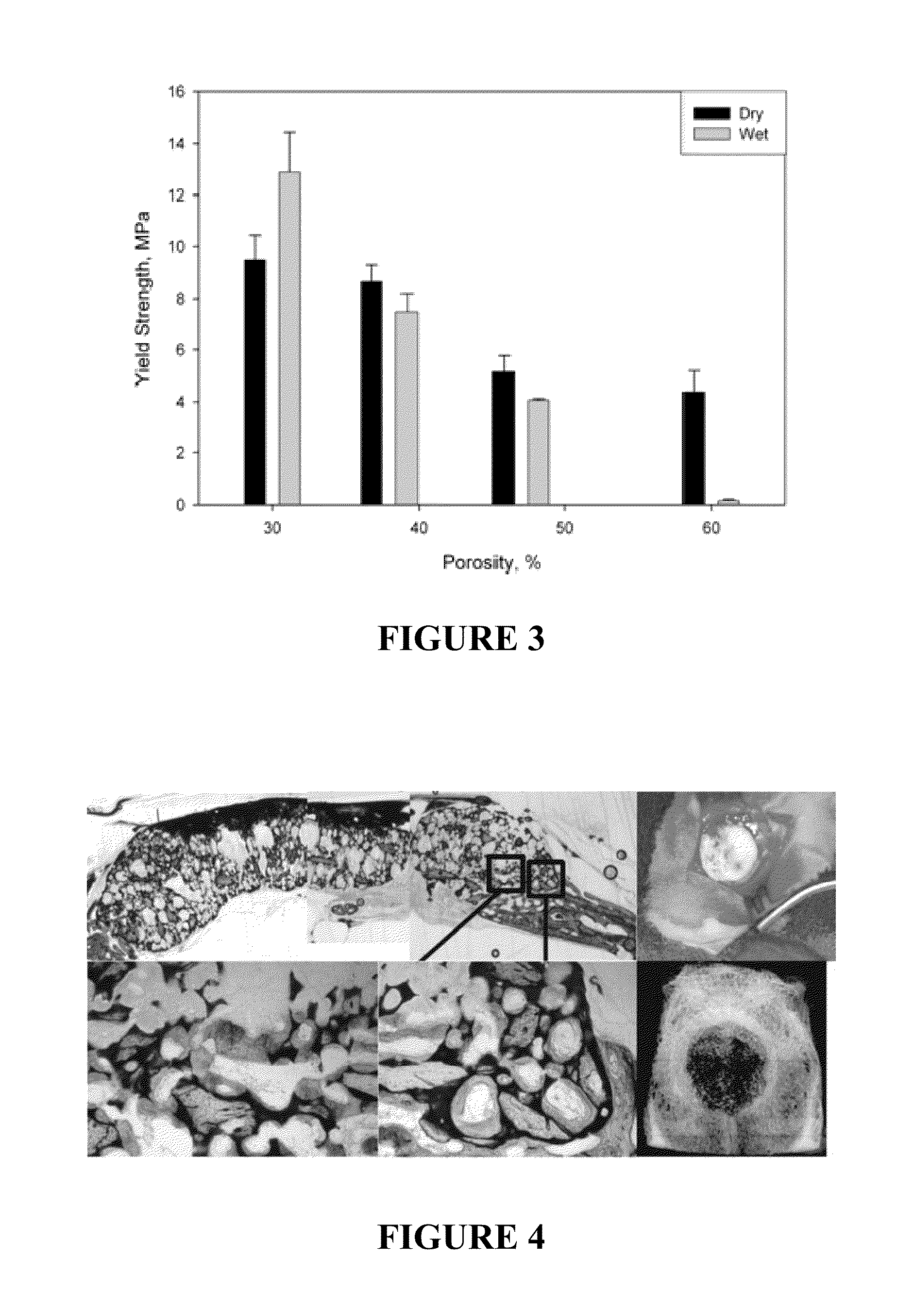 INJECTABLE ALLOGRAFT PUR COMPOSITE CARRYING rhBMP2