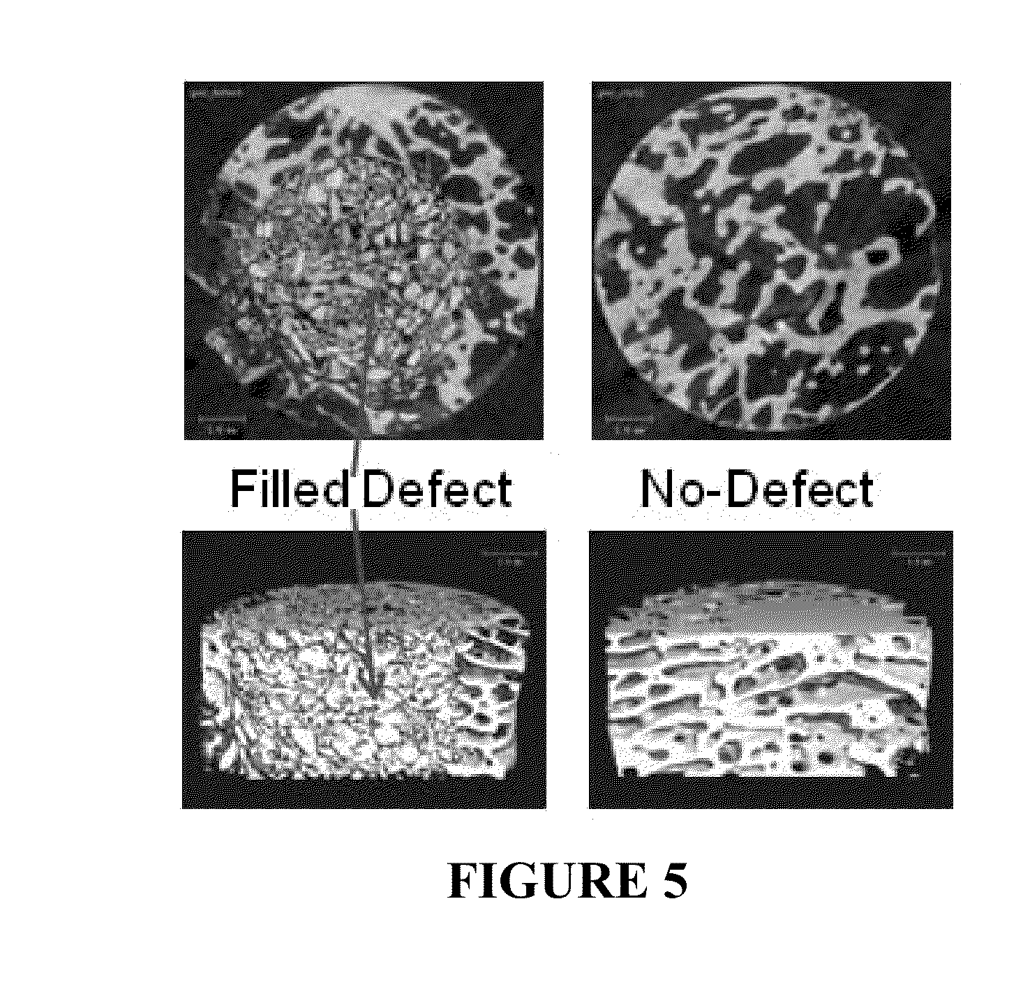 INJECTABLE ALLOGRAFT PUR COMPOSITE CARRYING rhBMP2