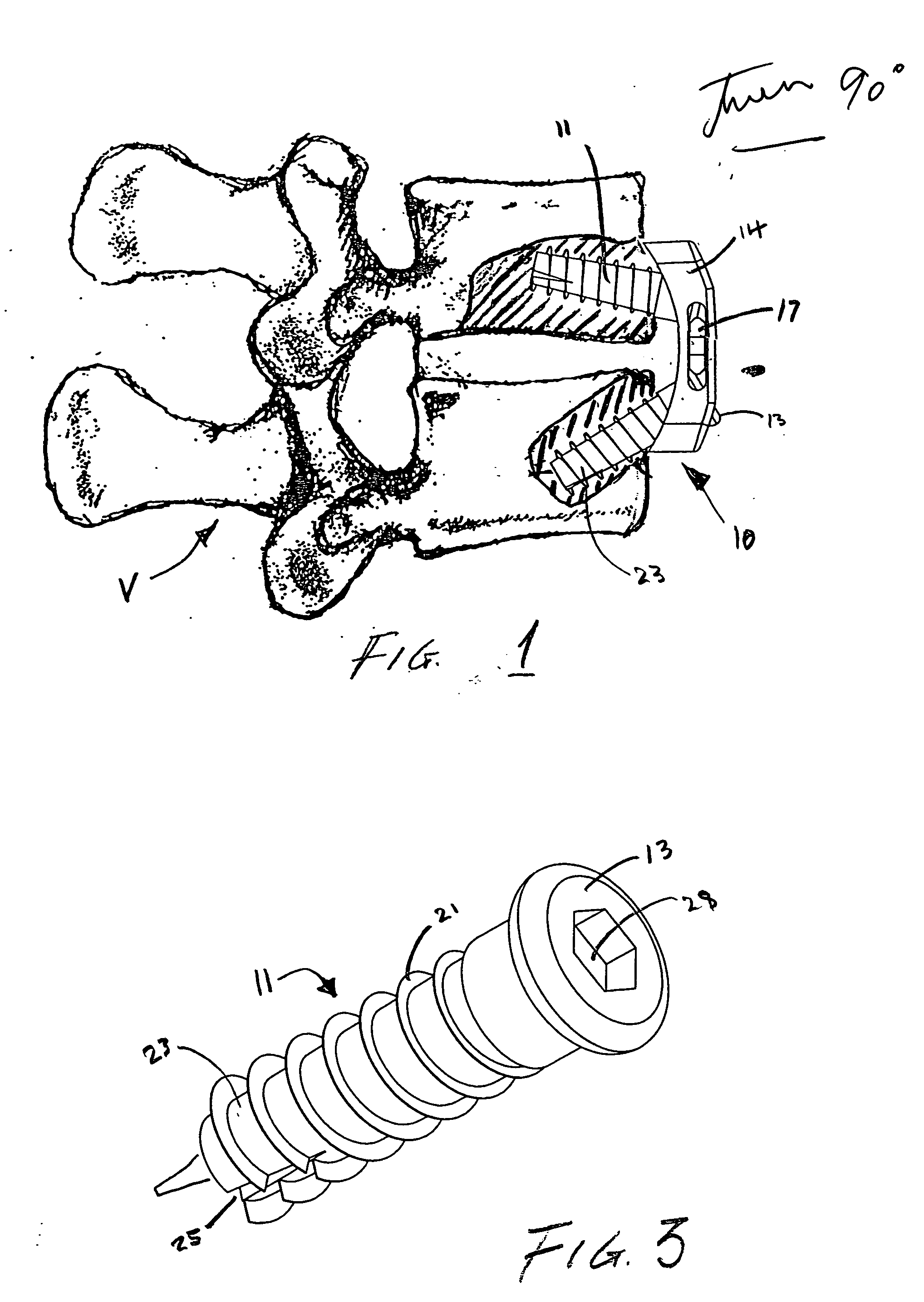 Static anterior cervical plate