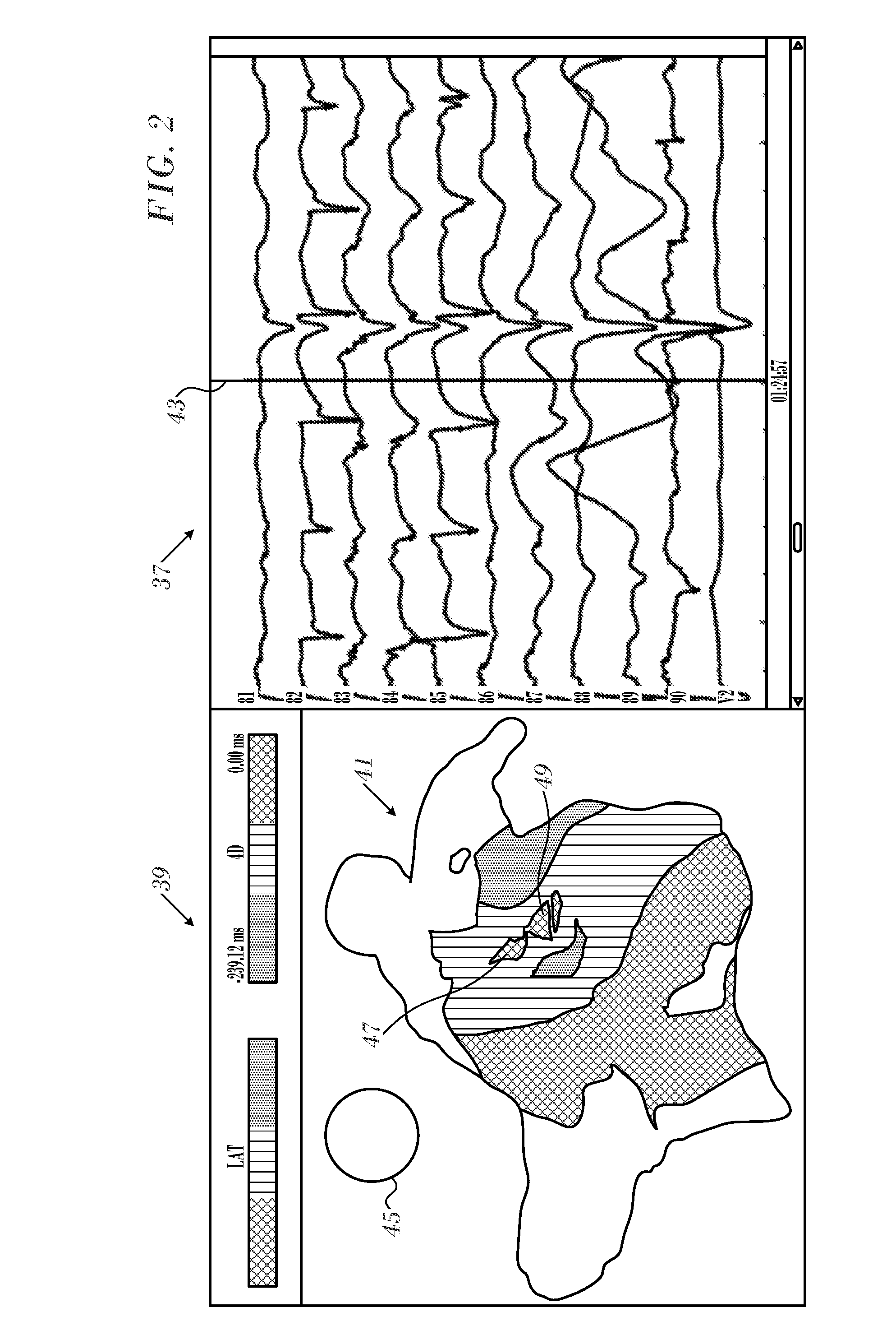 Ventricular electrical activity indicator