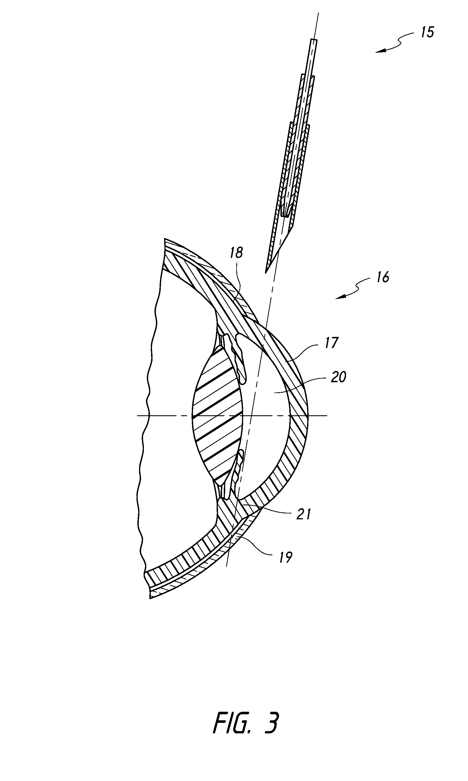 Intraocular devices