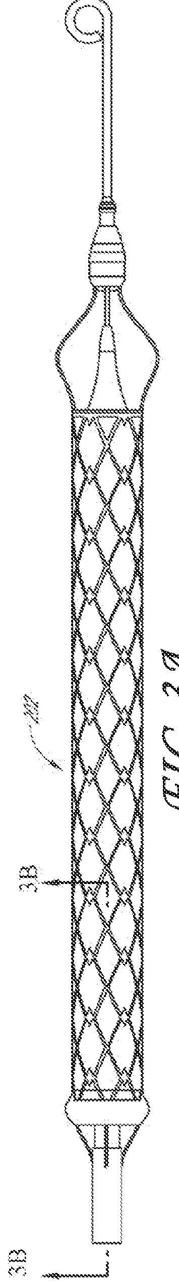 Catheter pump assembly including a stator