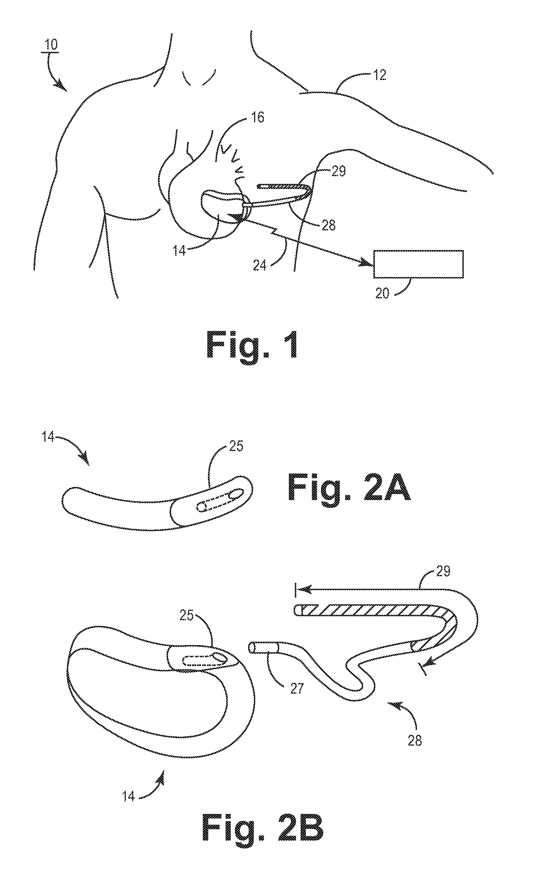 Subcutaneous lead fixation mechanisms