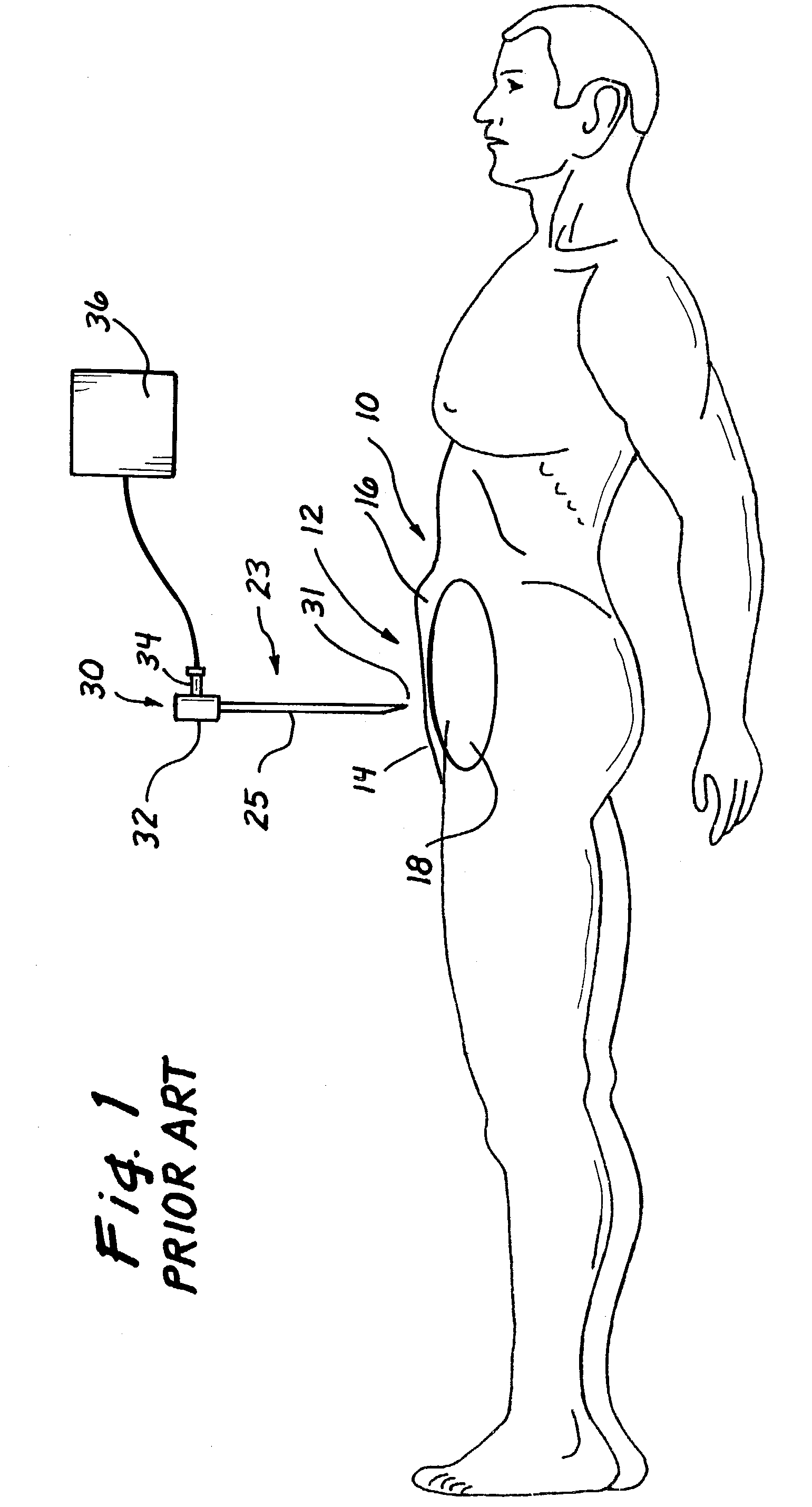 Surgical access apparatus and method